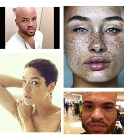 Do you have freckles? Join our Freckle Campaign!