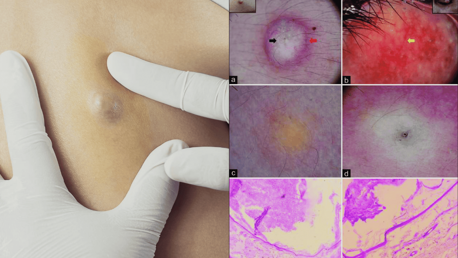 Dermatoscopy of Pilar and Sebaceous Cysts
