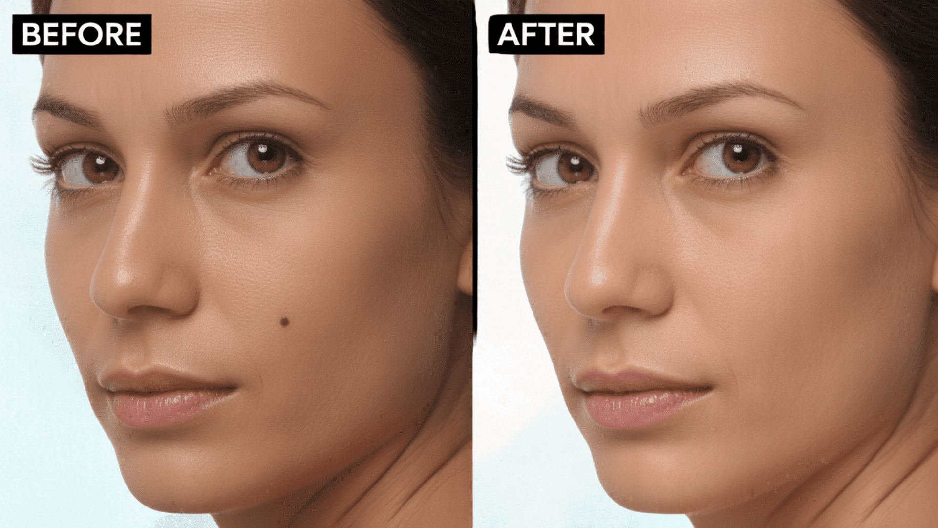 flat mole removal before and after