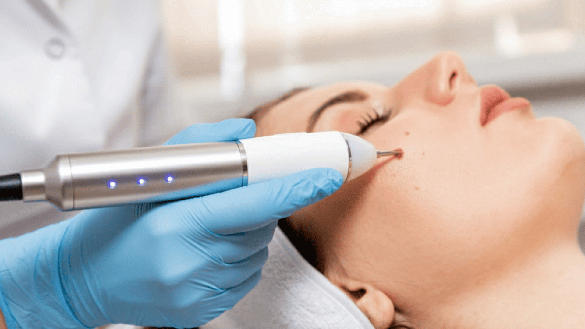 flat mole removal near me