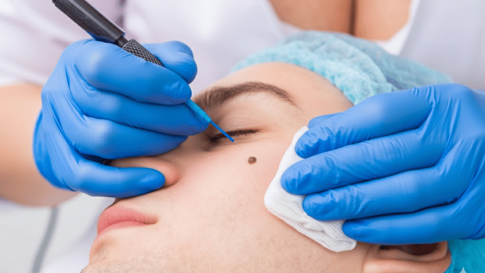 laser flat mole removal