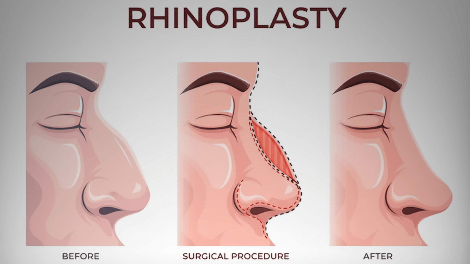 septoplasty vs rhinoplasty recovery time
