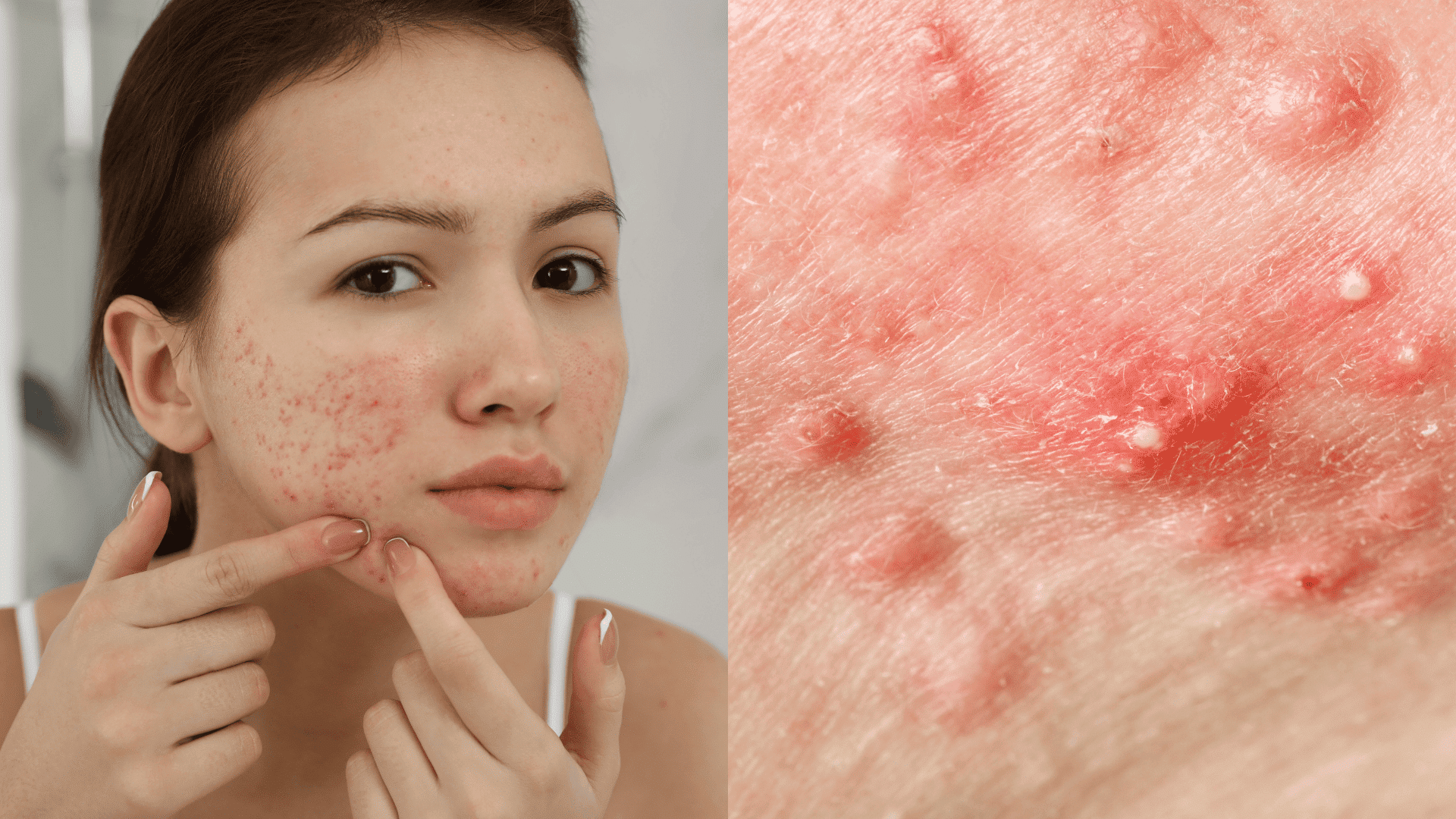 signs of retinol purge acne breakouts