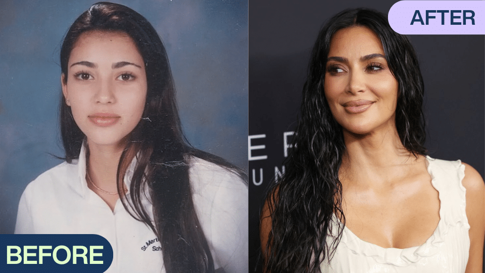 KIM KARDASHIAN BEFORE AND AFTER SURGERY