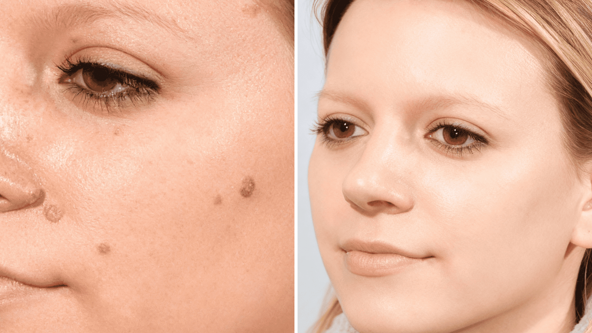 beauty mark removal before and after