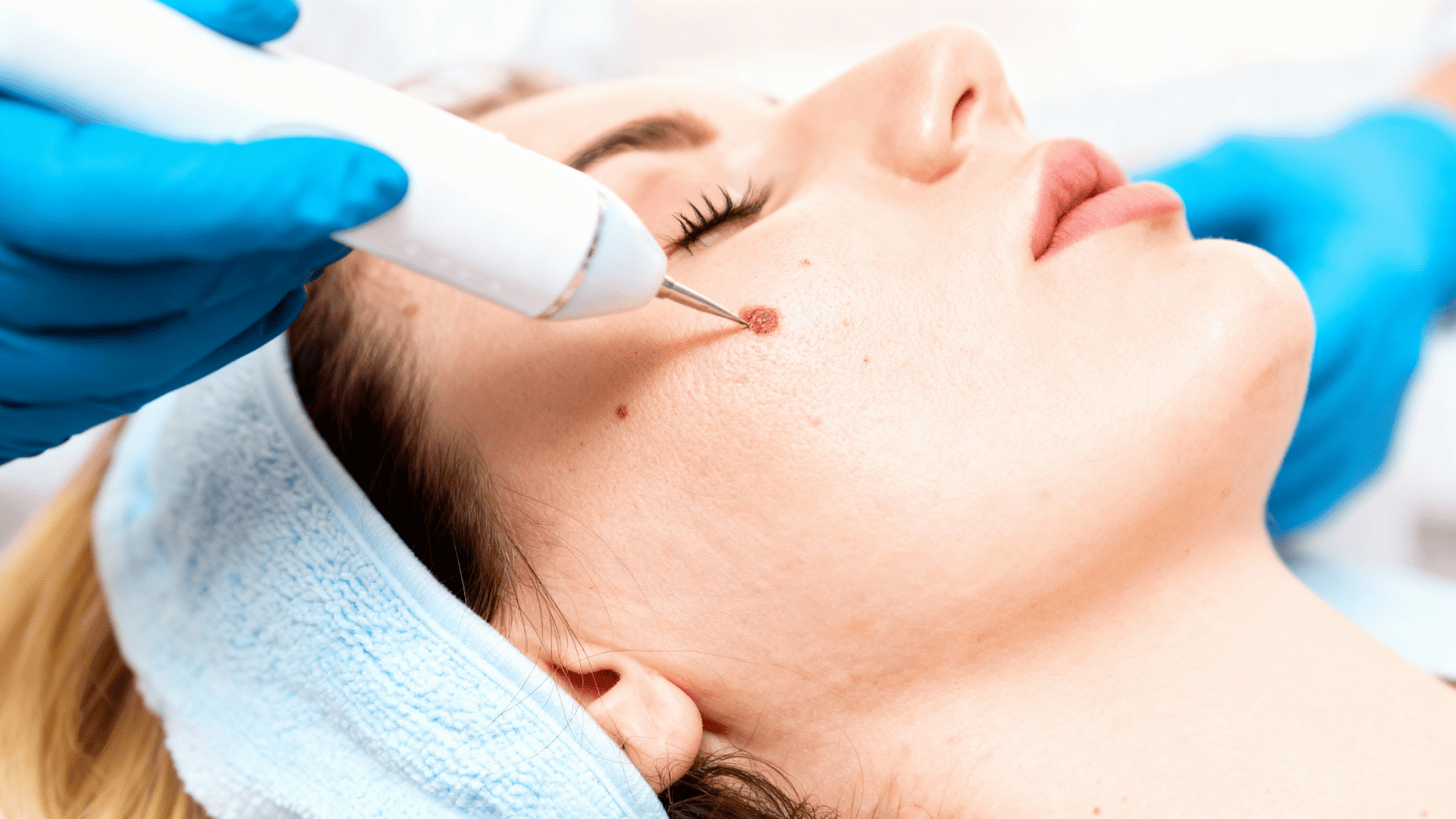 beauty mark removal laser