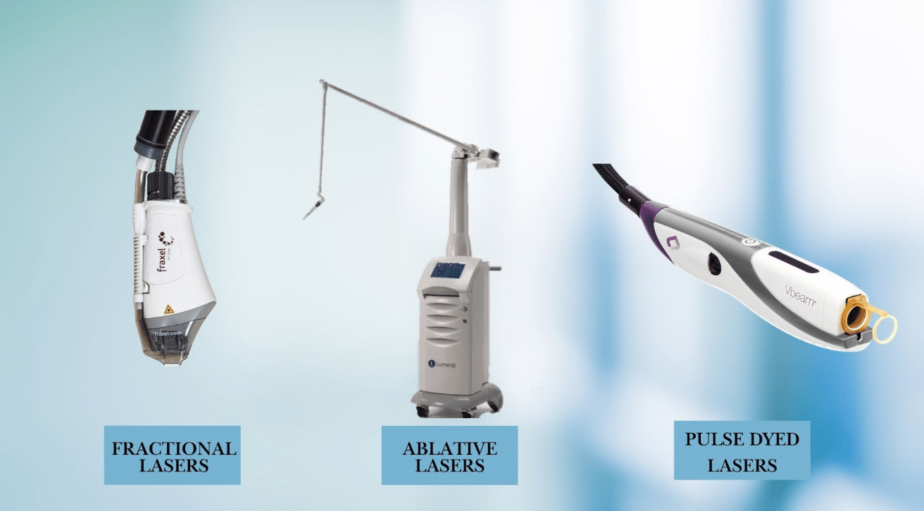 Types of Stretch Mark Removal Lasers