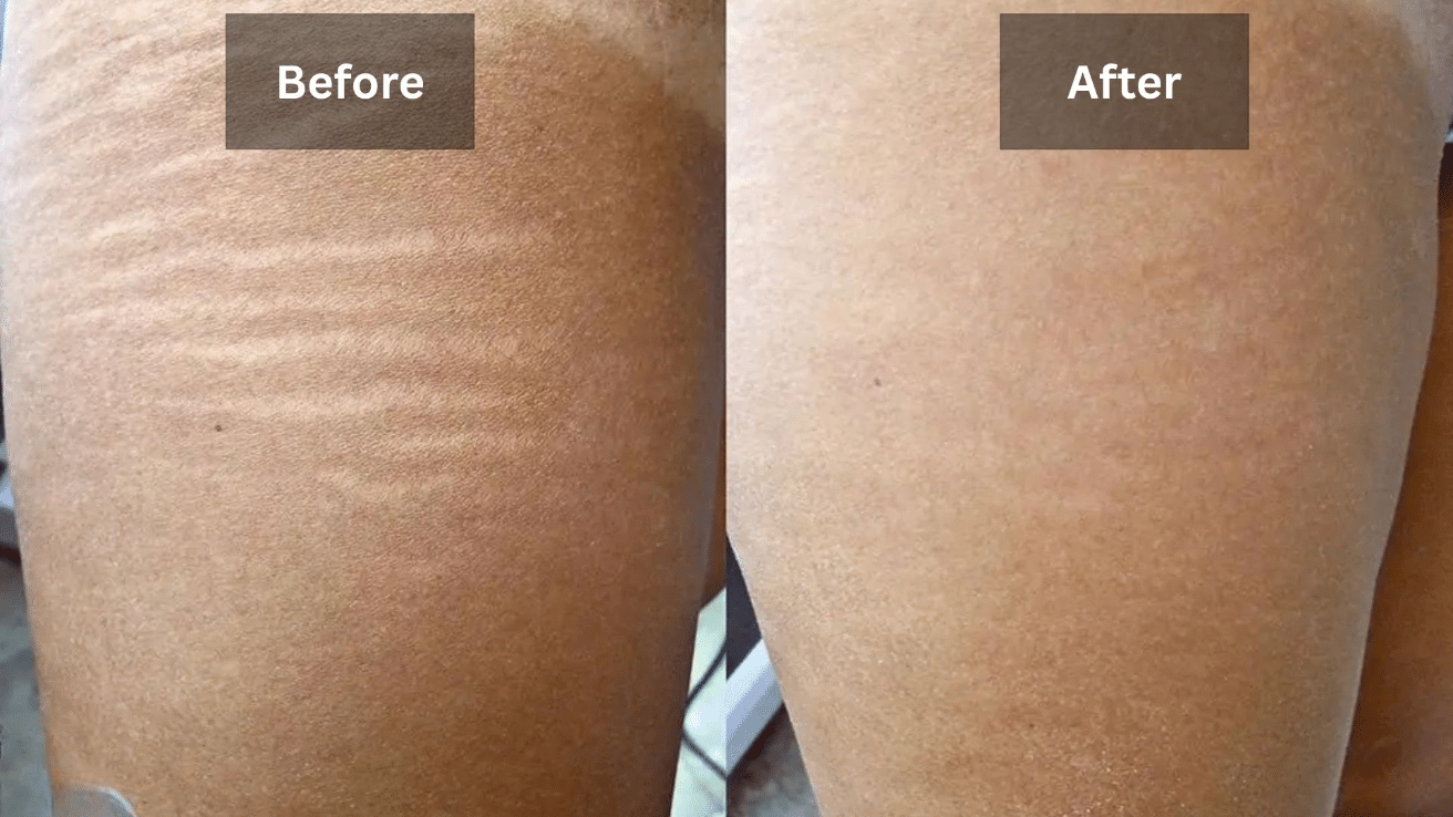 Effectiveness of Stretch Mark Removal Lasers
