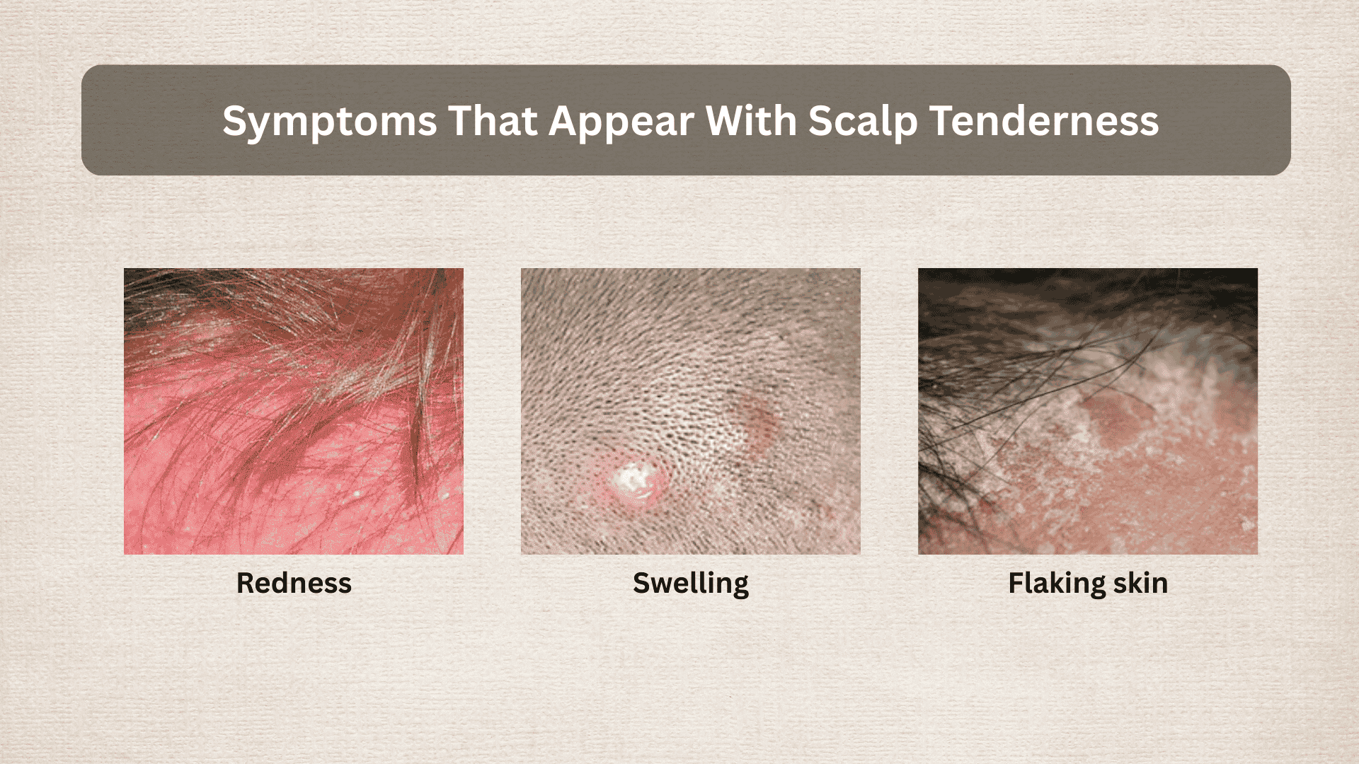Infographic showing scalp tenderness symptoms including redness, swelling bumps, and flaking scalp skin