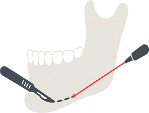 Chin or Jaw Surgery
