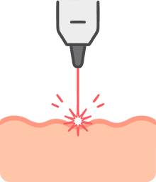 Laser Treatments