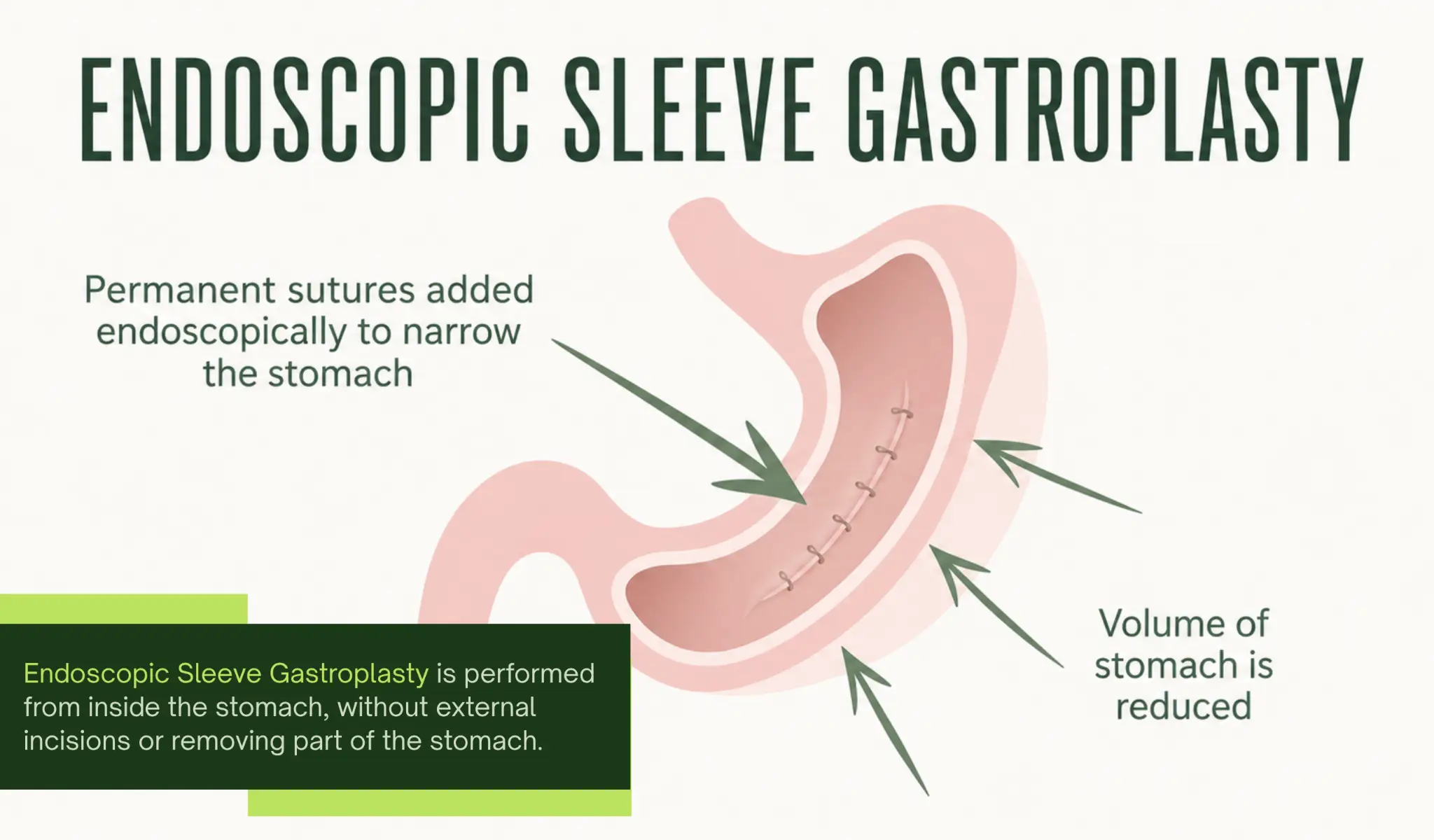 Illustration of stomach with sutures applied endoscopically to reduce its volume