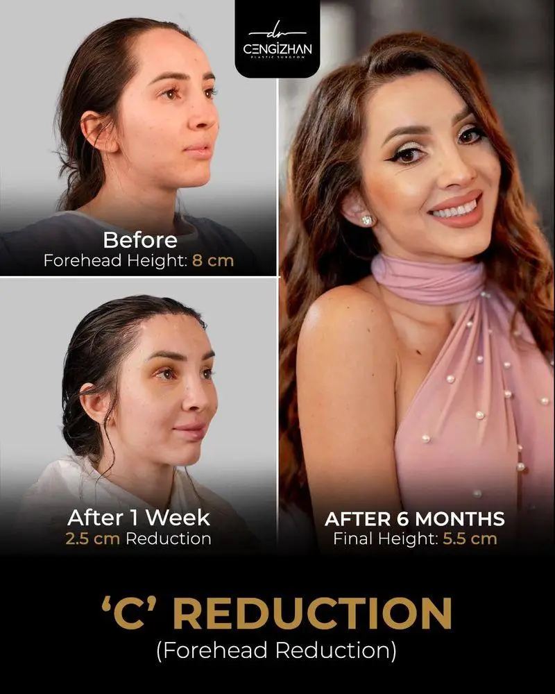 Side view of woman in three stages of forehead reduction procedure transformation