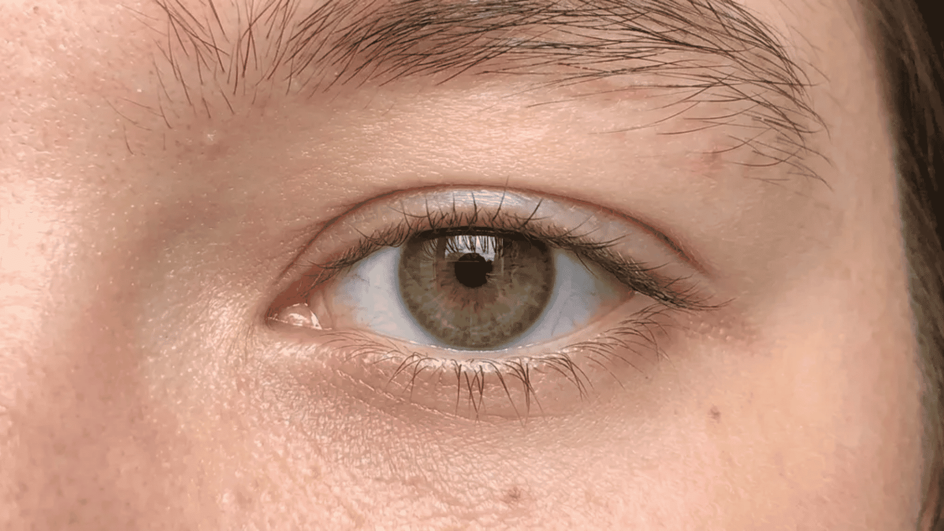 Close-up of a double eyelid showing a single defined crease dividing the upper lid into two distinct sections.