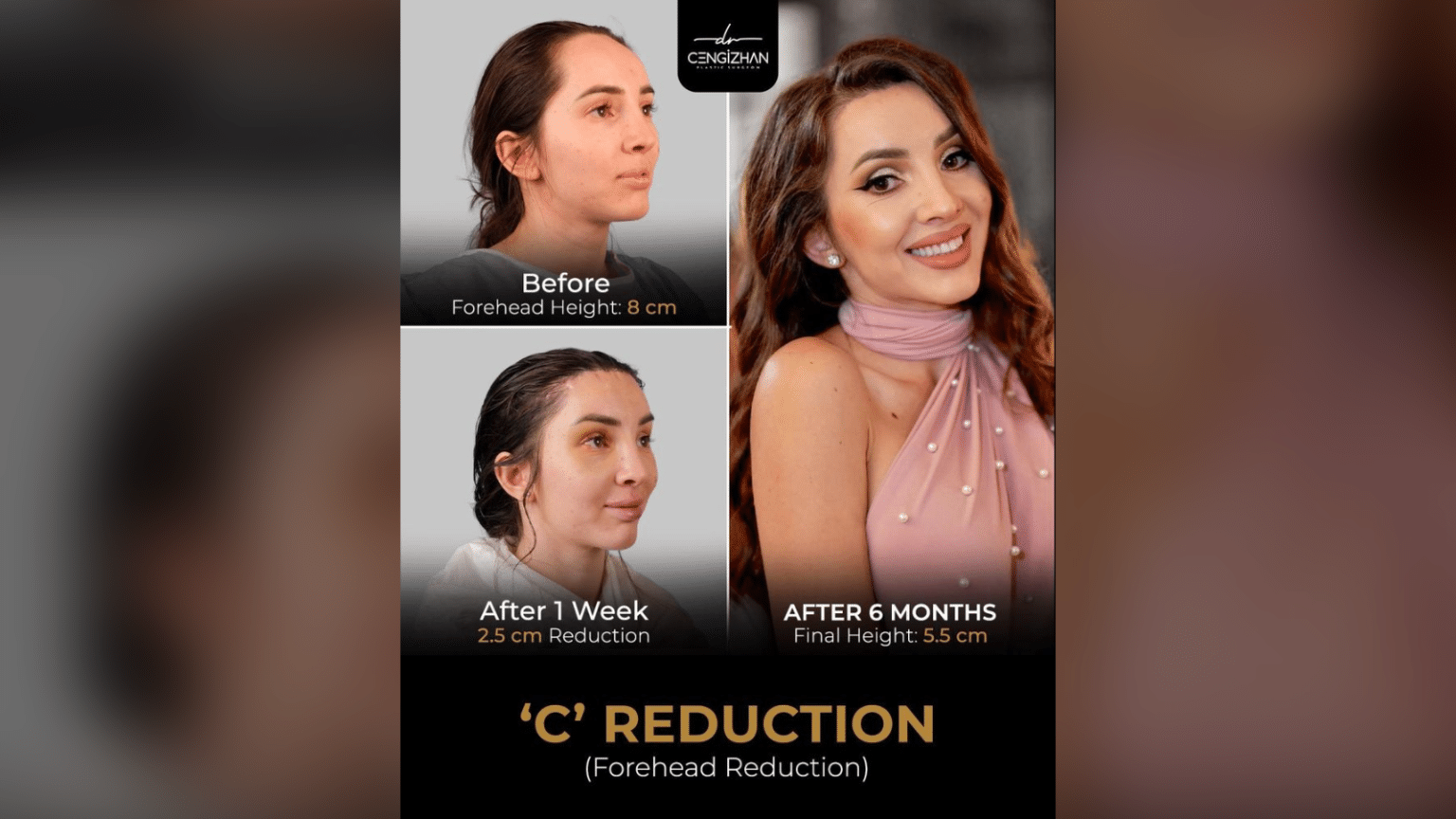 The Benefits of Forehead Reduction Surgery in Turkey for Natural Facial Proportions