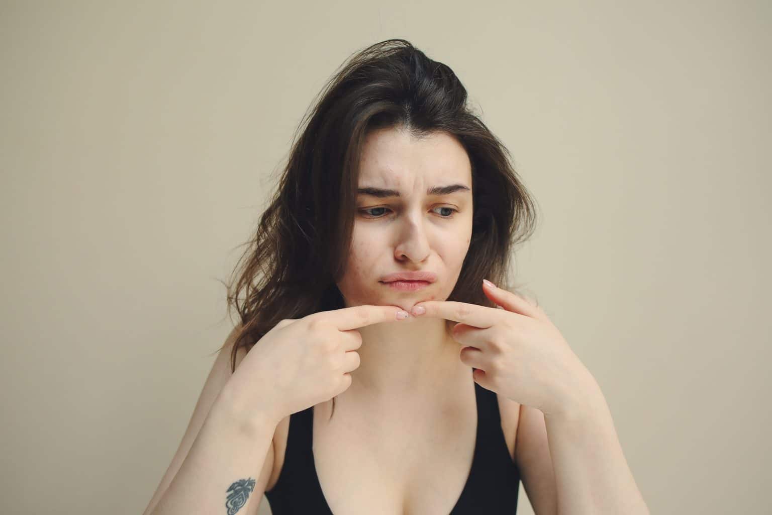 Closed Comedones and Comedonal Acne: Causes, Treatments, and Prevention Tips