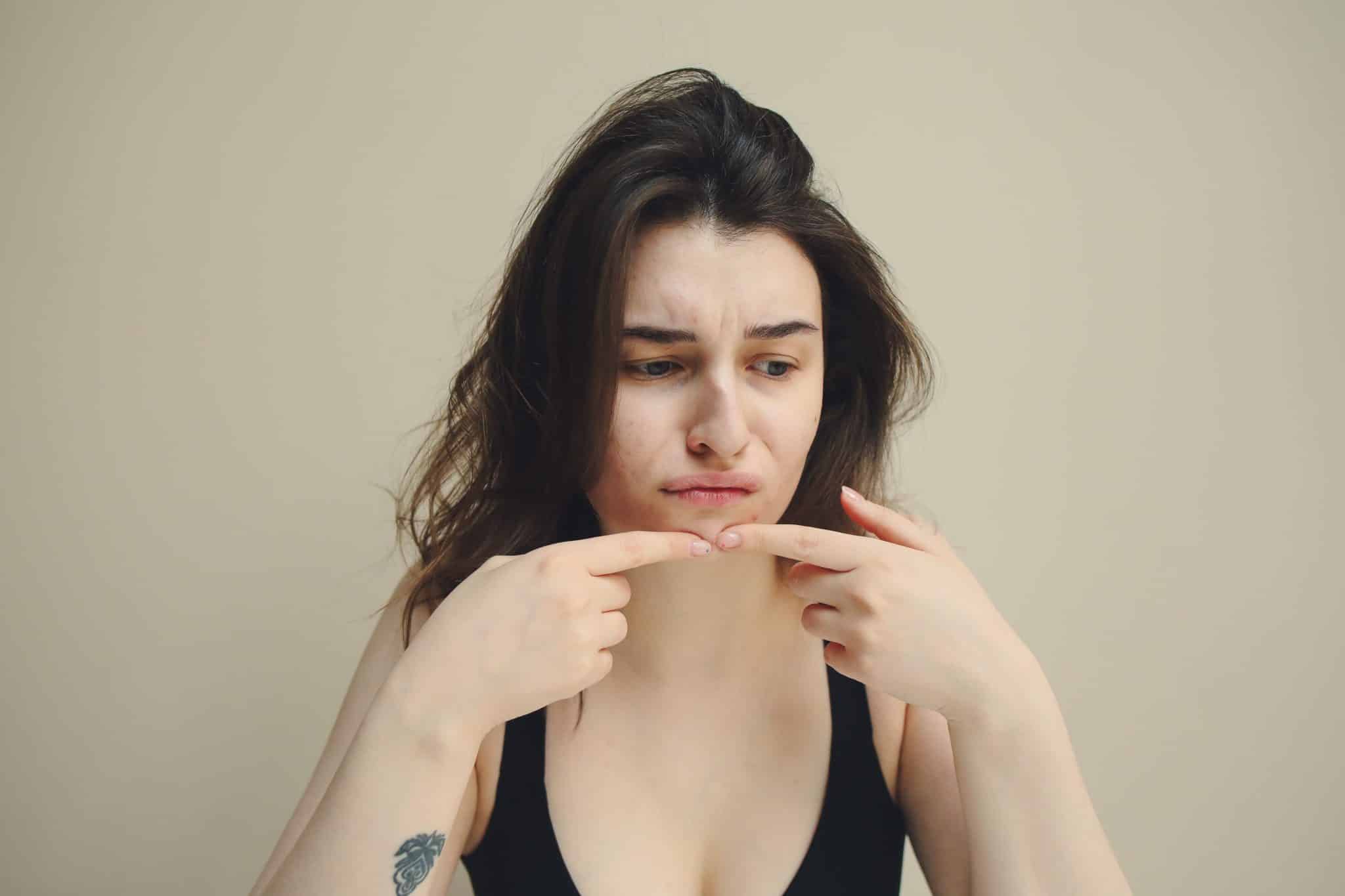 Closed Comedones and Comedonal Acne: Causes, Treatments, and Prevention Tips