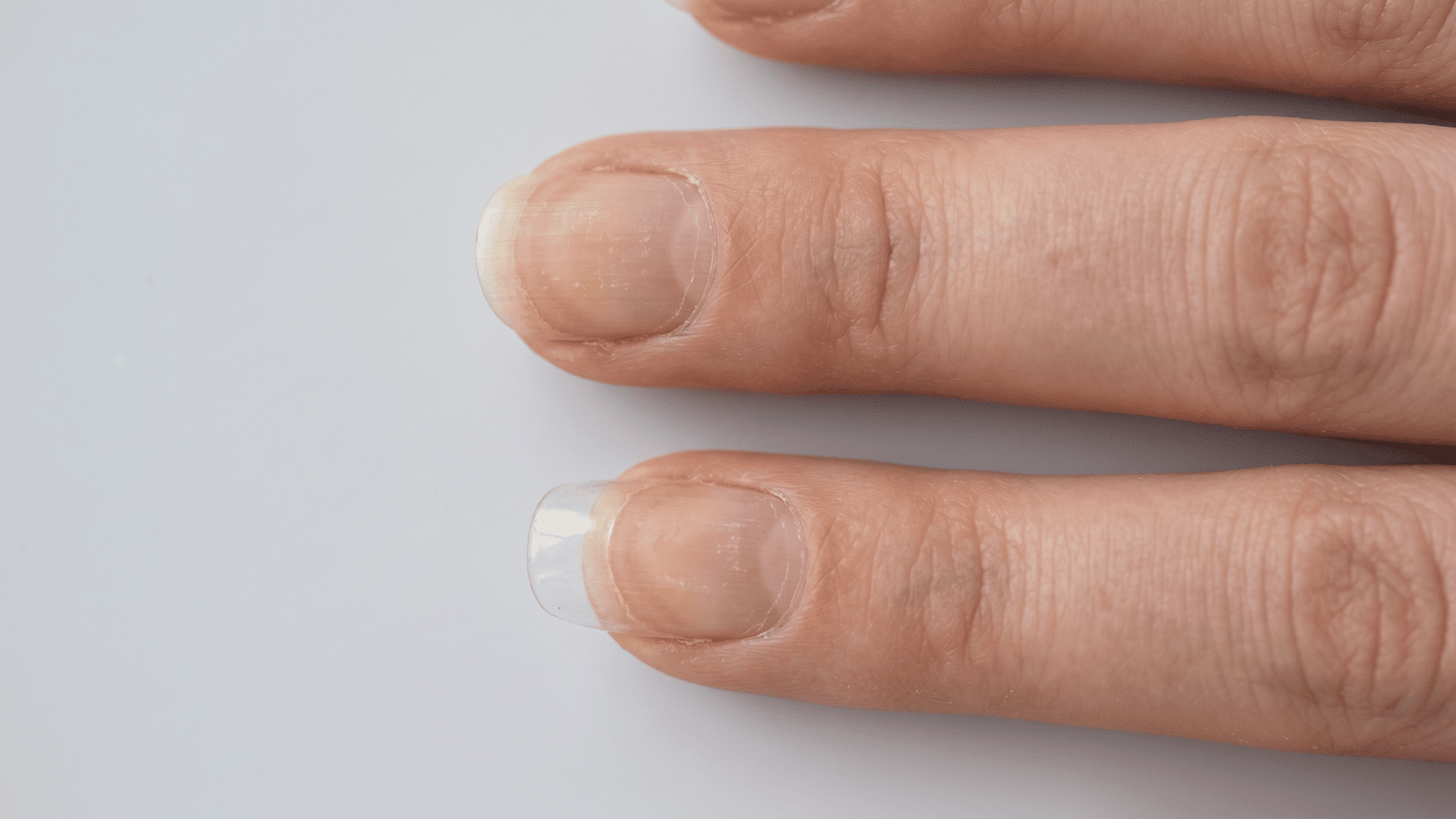 Natural nails with mild yellow staining after polish removal beside a fingernail with a clear acrylic overlay.
