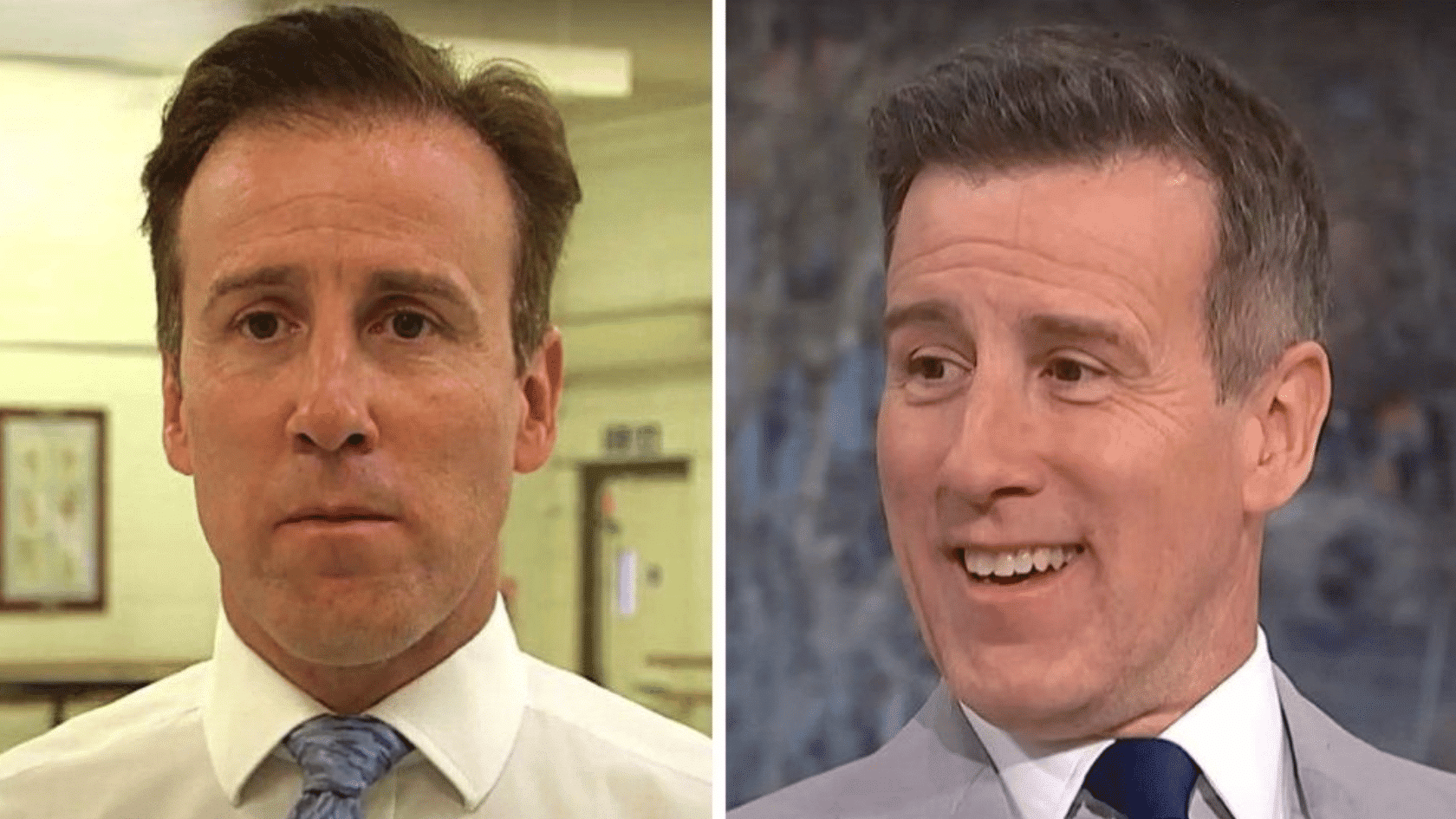 Side-by-side comparison of Anton Du Beke before and after a hair transplant procedure.