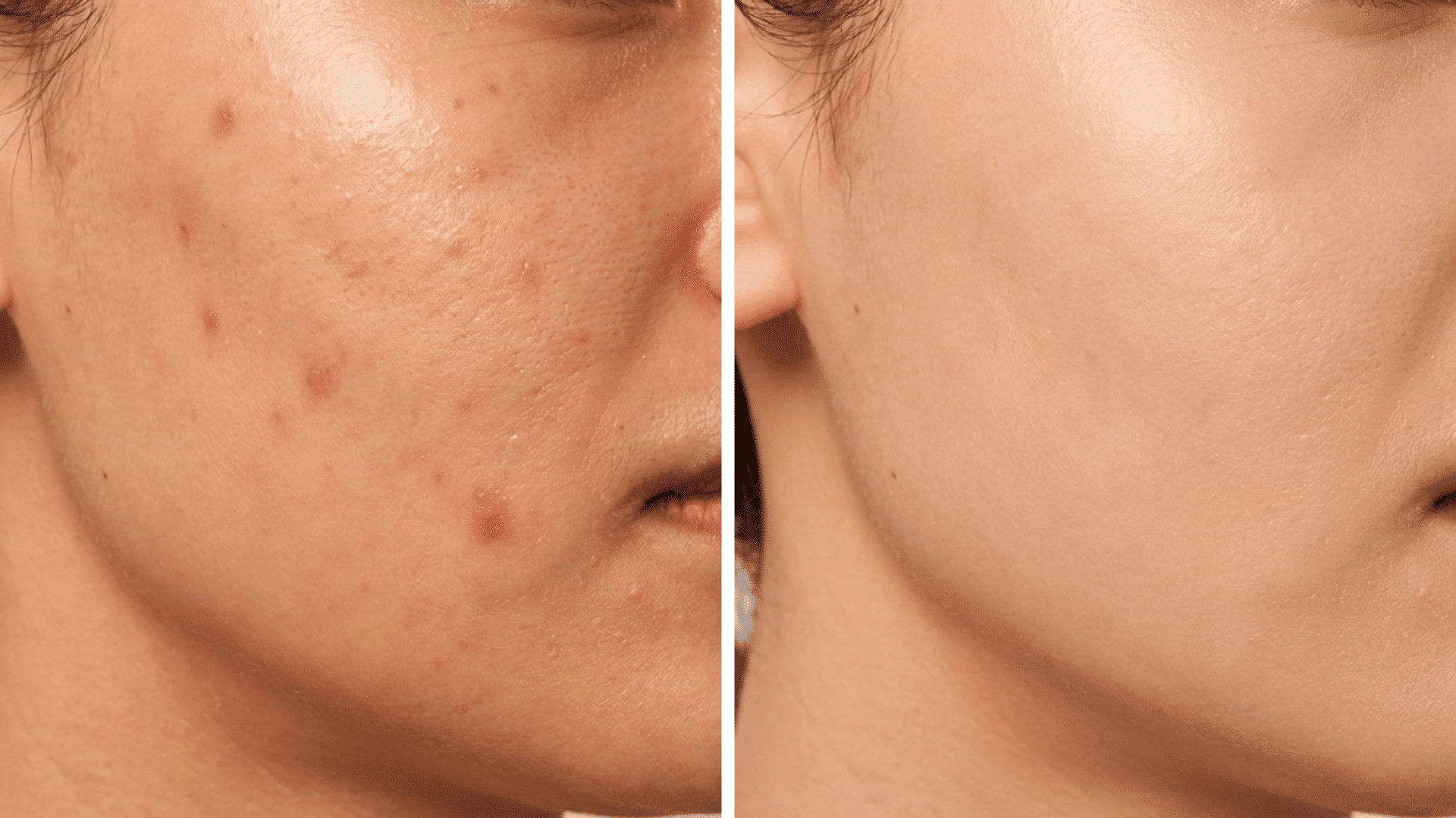 before-and-after-close-up-of-a-person-s-cheek-showing-acne-and-blemishes-on-the-left-and-clear-smooth-skin-on-the-right