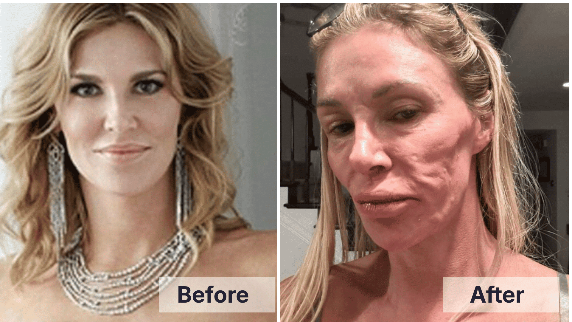Brandi Glanville before and after facial changes shown in a split image for worst celebrity plastic surgery examples.