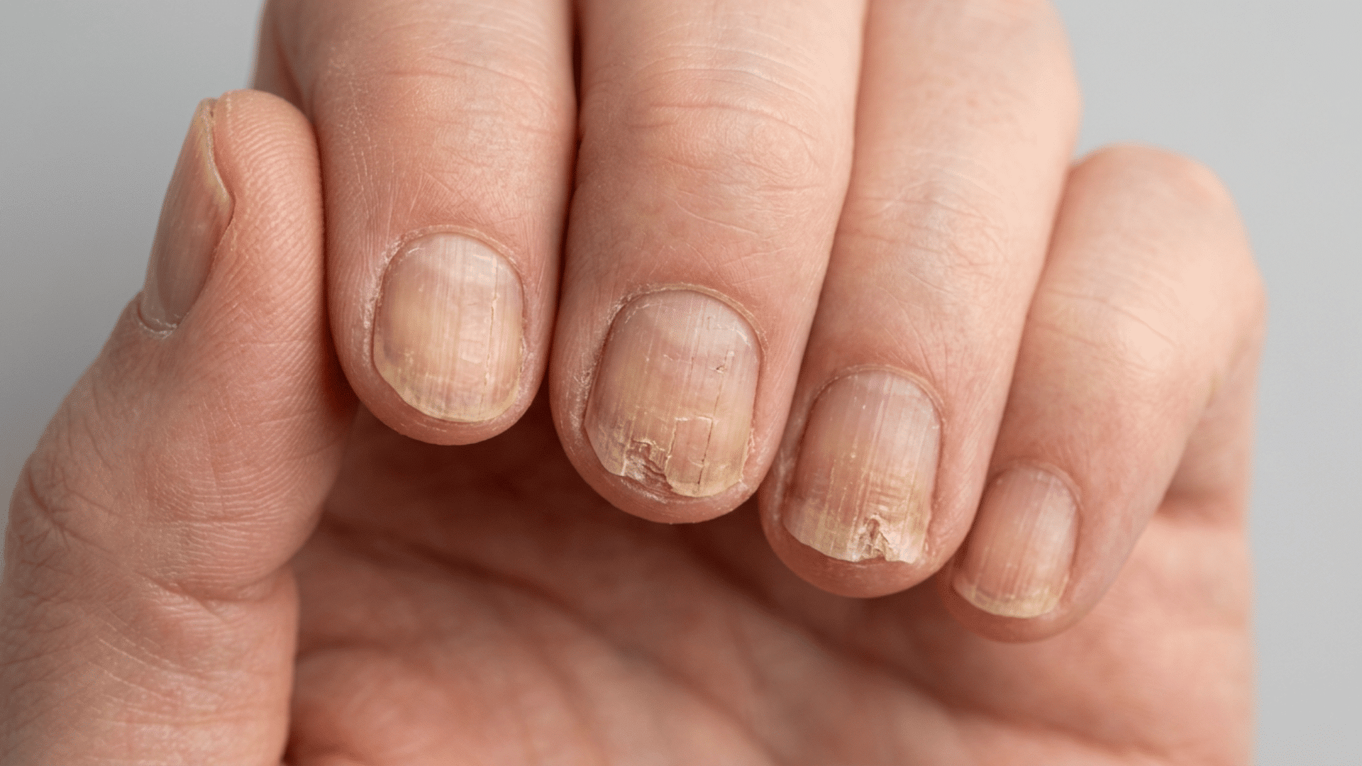 Close-up of fingernails with thickening, ridges, cracks, and crumbly edges.