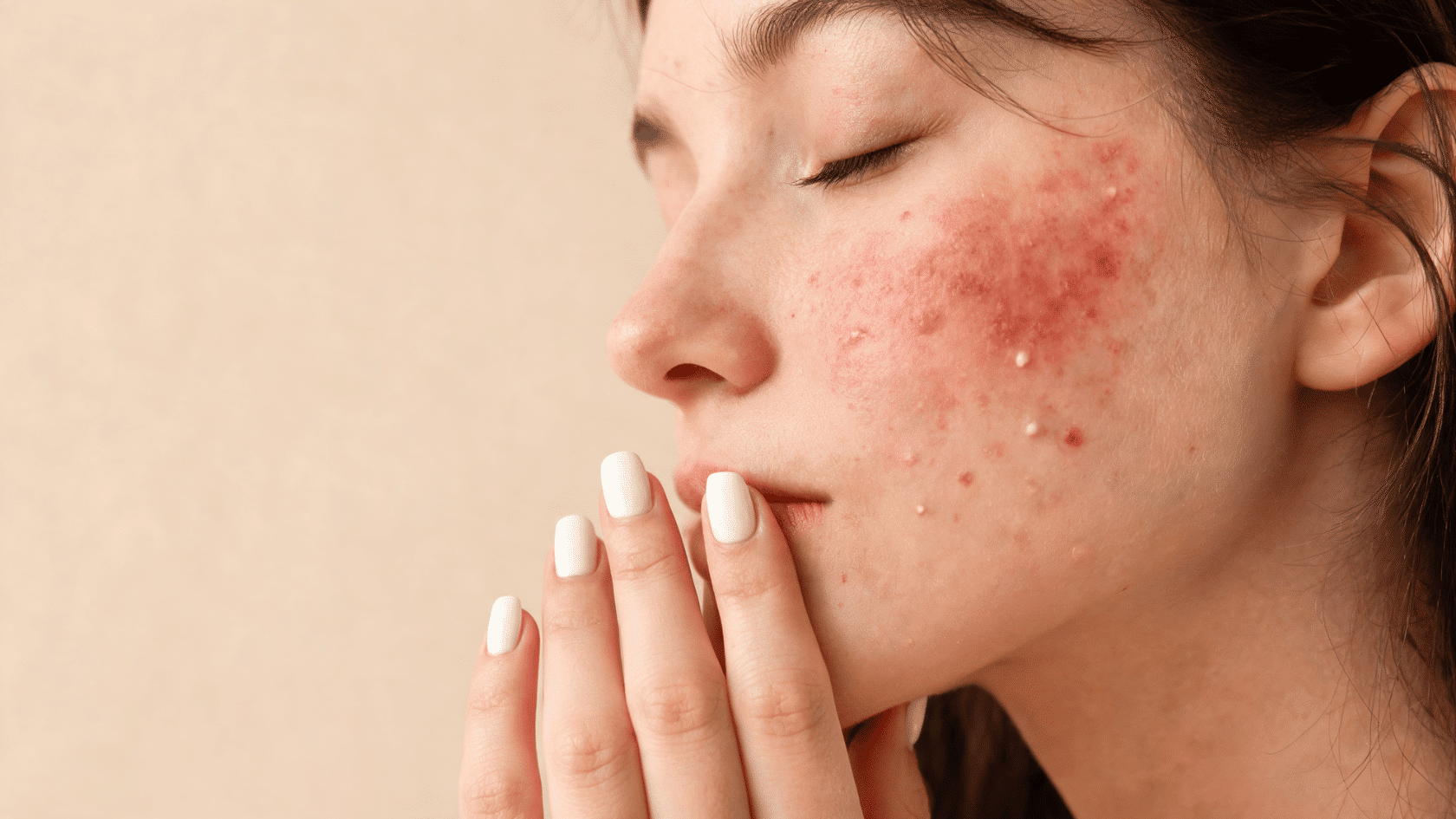 Close-up view of irritated facial skin with redness, small bumps, and dry patches on the cheek.