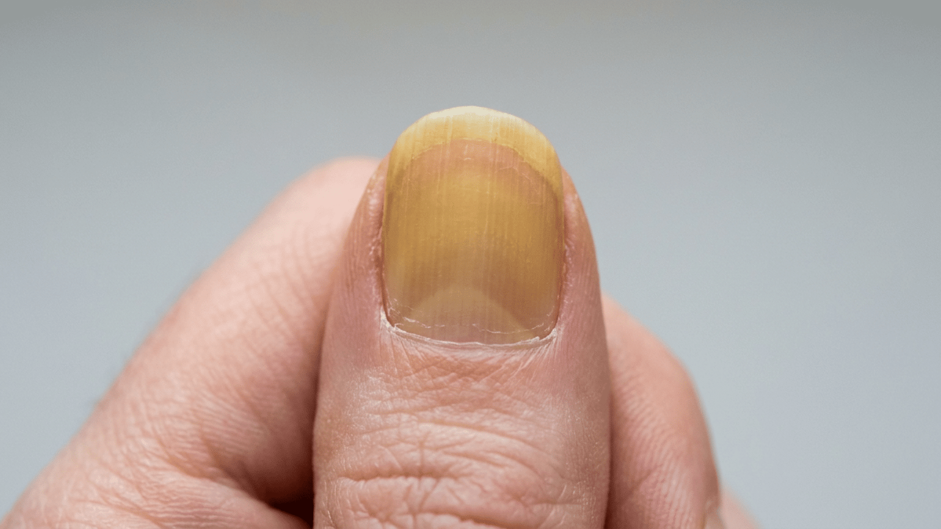 Fingernail with yellow discoloration extending from the cuticle to the tip.