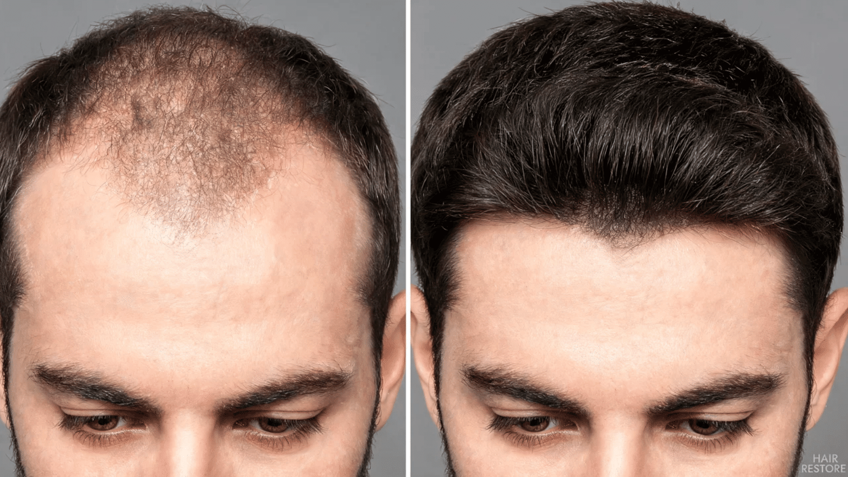 Before and after <echighlighted>hairline surgery</echighlighted> showing fuller front hair growth and improved hairline