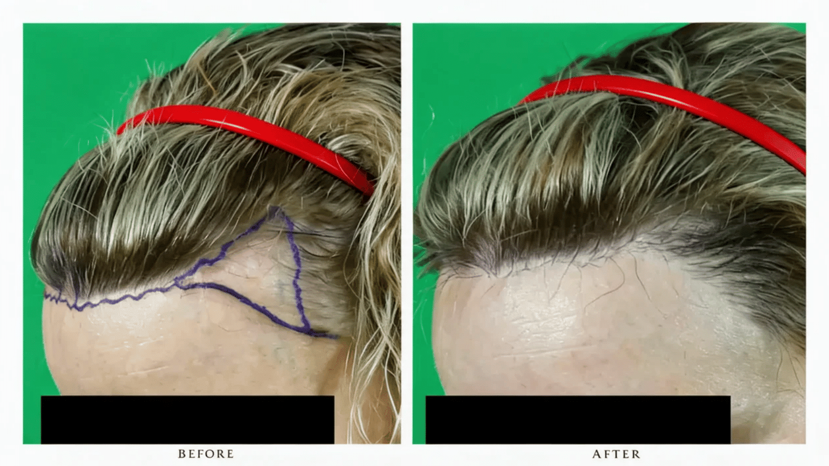 Before and after <echighlighted>hairline surgery</echighlighted> showing marked hairline design and fuller front hair growth
