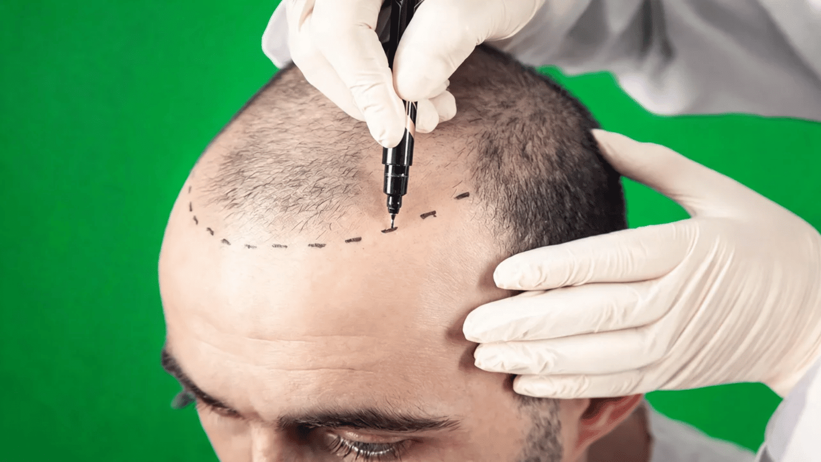 Doctor marks scalp for hairline surgery before hair transplant planning