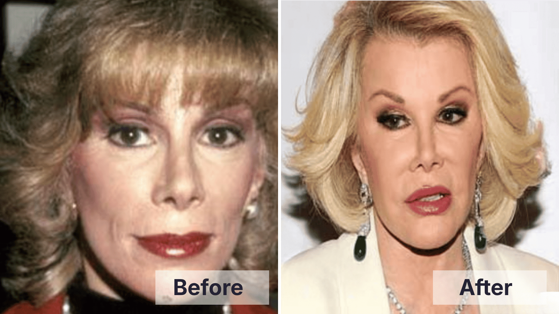 Joan Rivers facial changes featured in worst celebrity plastic surgery discussions