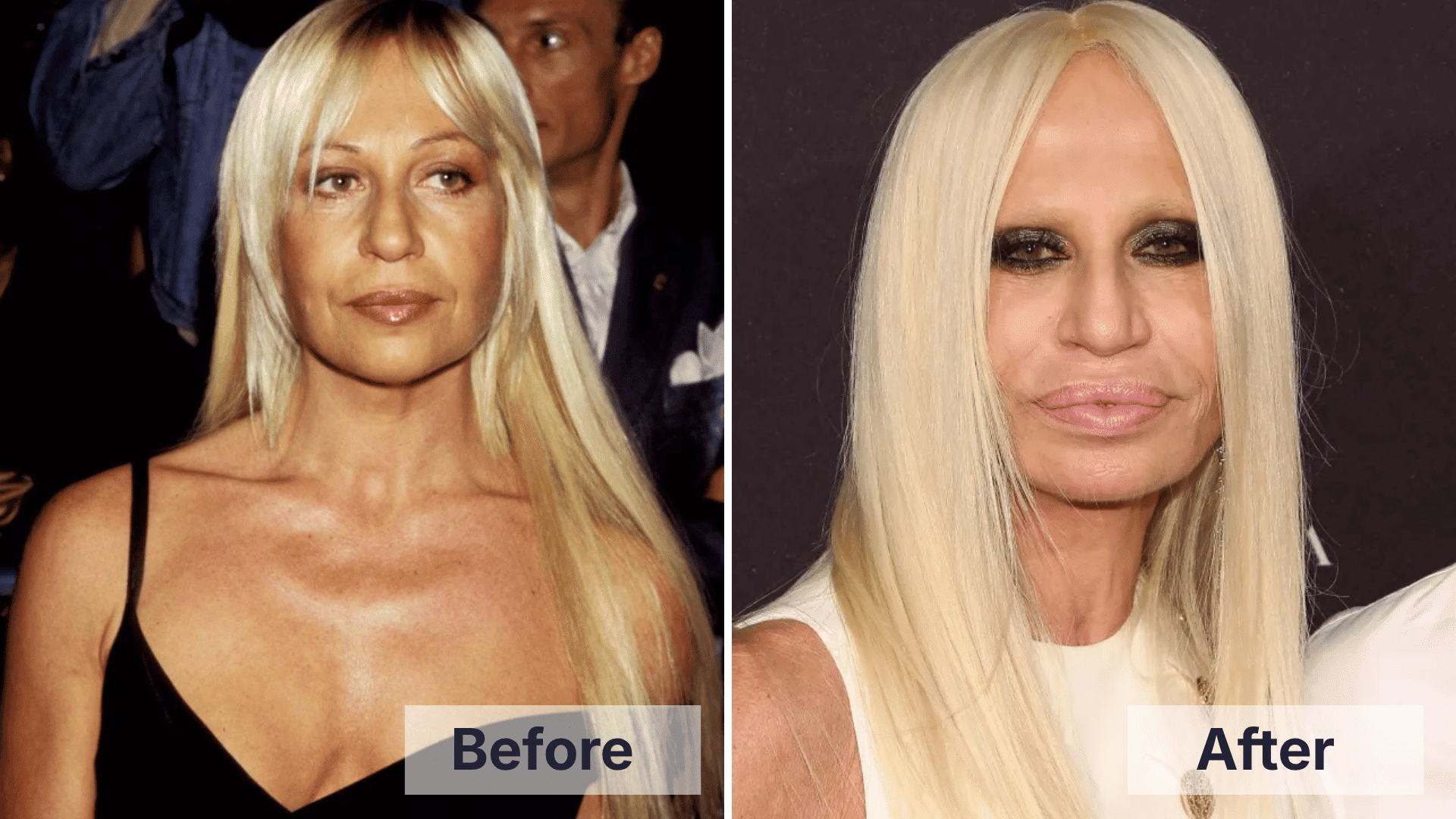 Donatella Versace before and after facial changes shown in a split image for worst celebrity plastic surgery examples.