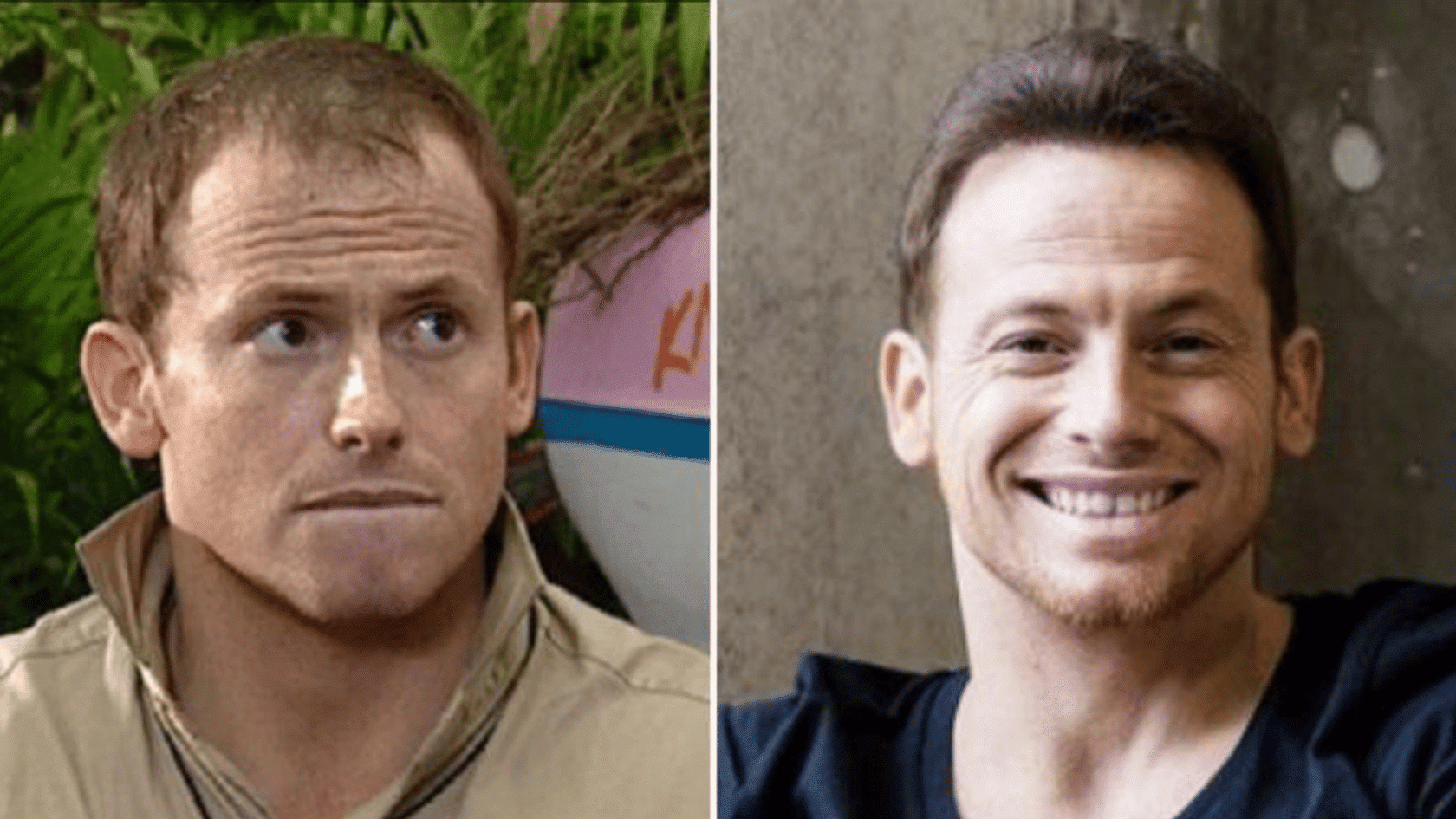 Side-by-side comparison of Joe Swash showing a before and after look following a hair transplant procedure.