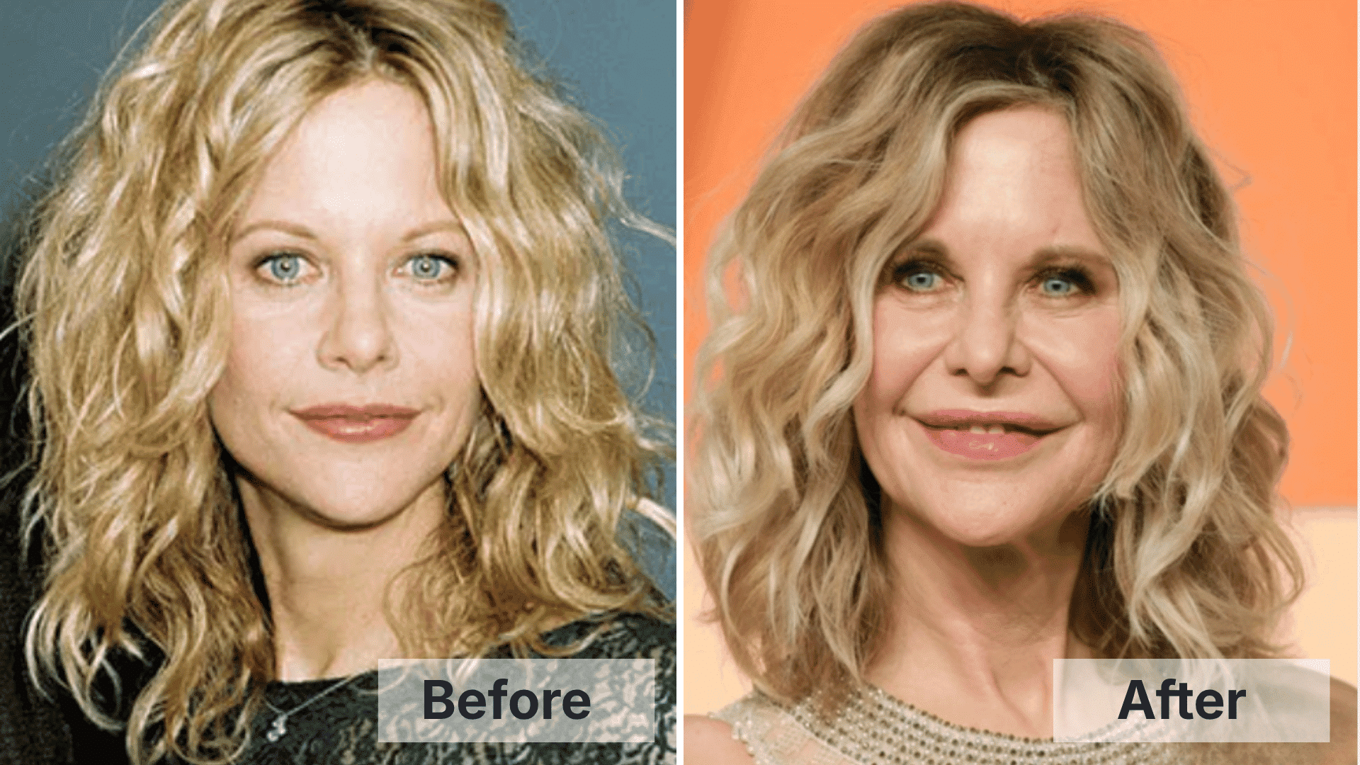 Meg Ryan before and after facial changes shown in a split image for worst celebrity plastic surgery examples.
