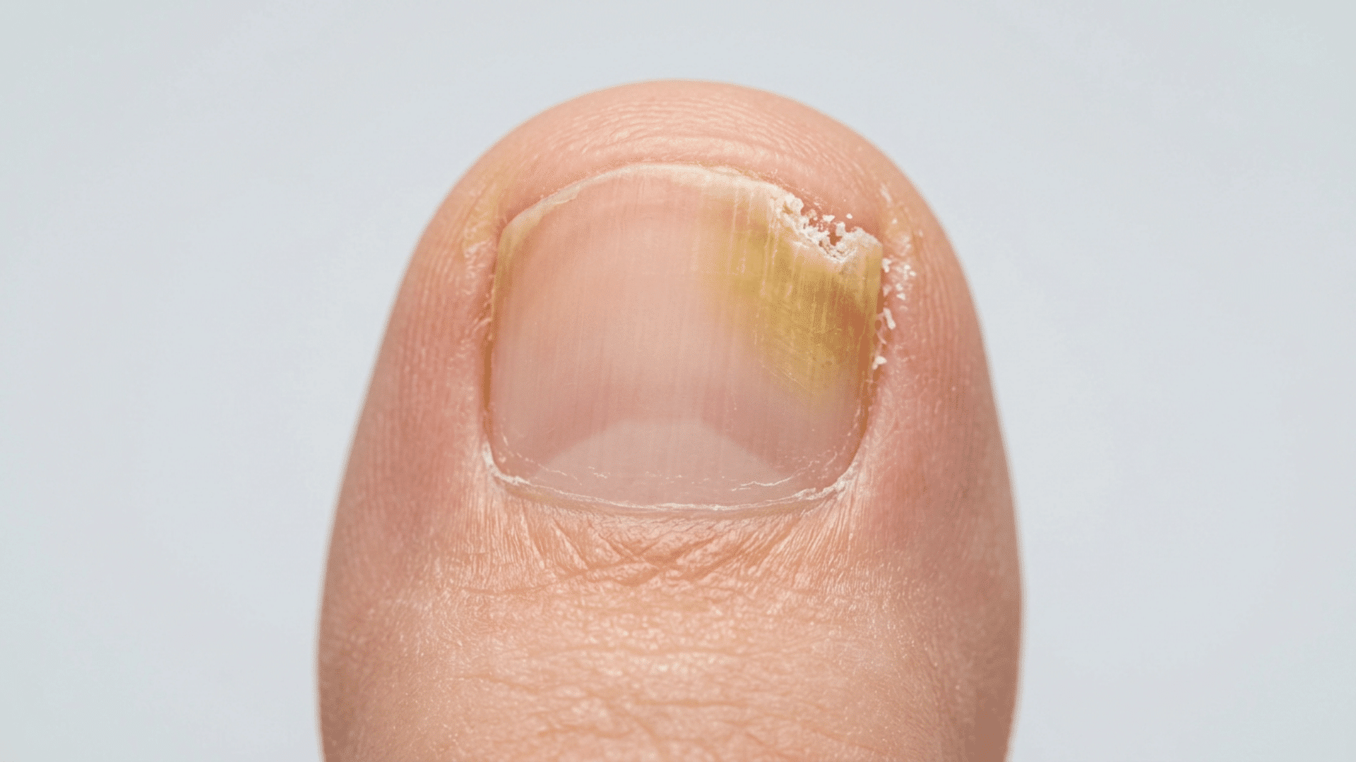 Toenail with yellow discoloration, thickening, crumbly edges, and slight lifting from the nail bed.