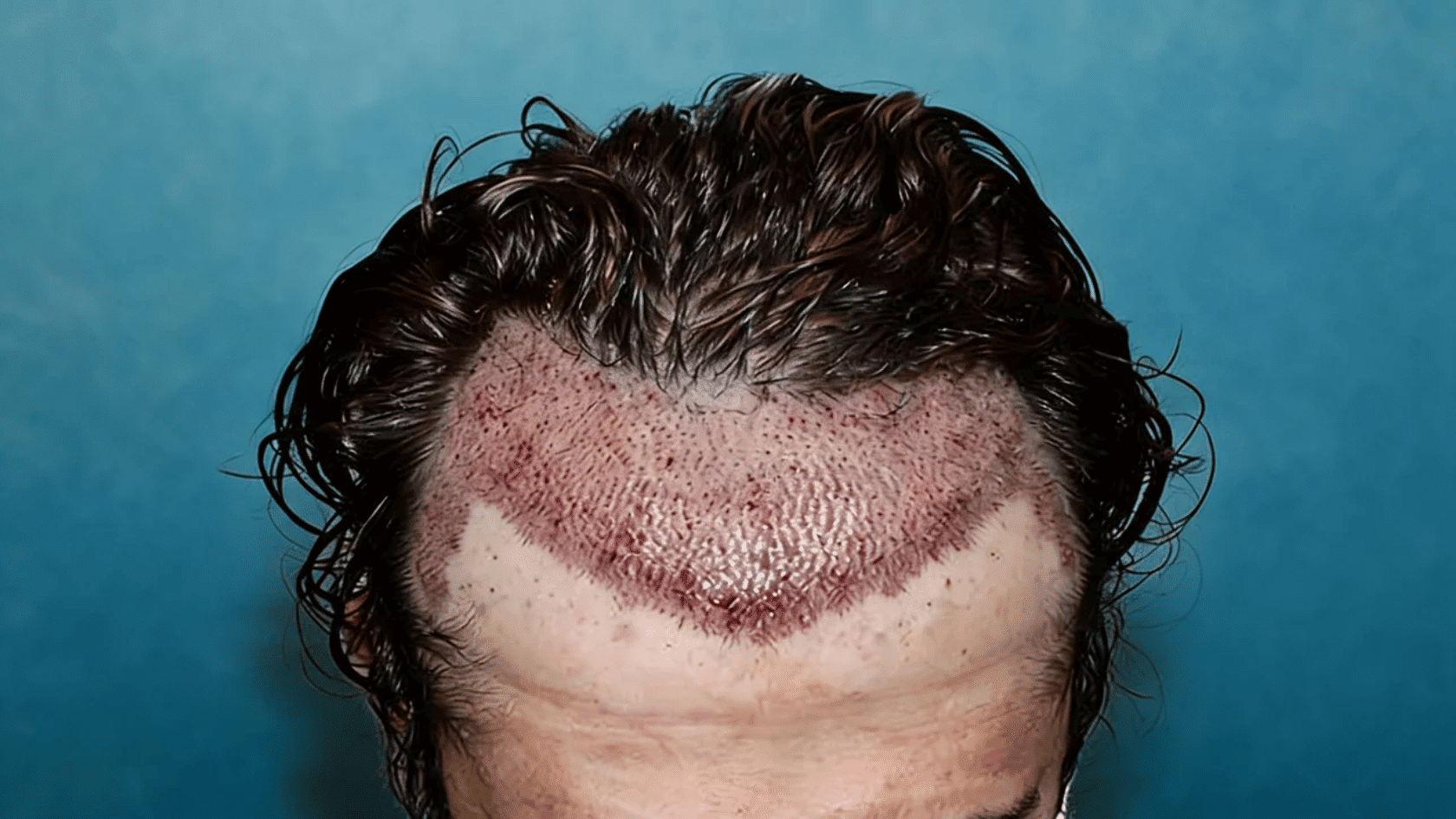 Hairline surgery result showing transplanted front hairline with healing scalp redness