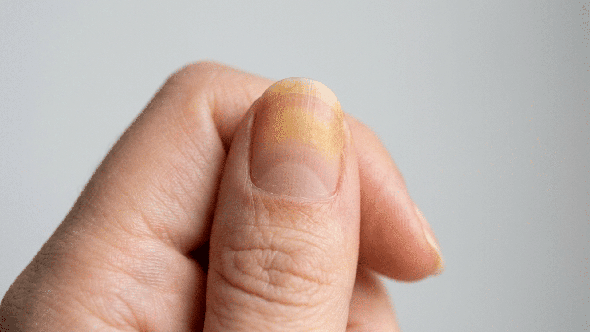 Yellow discoloration on the upper half of a fingernail with clear new growth near the cuticle.