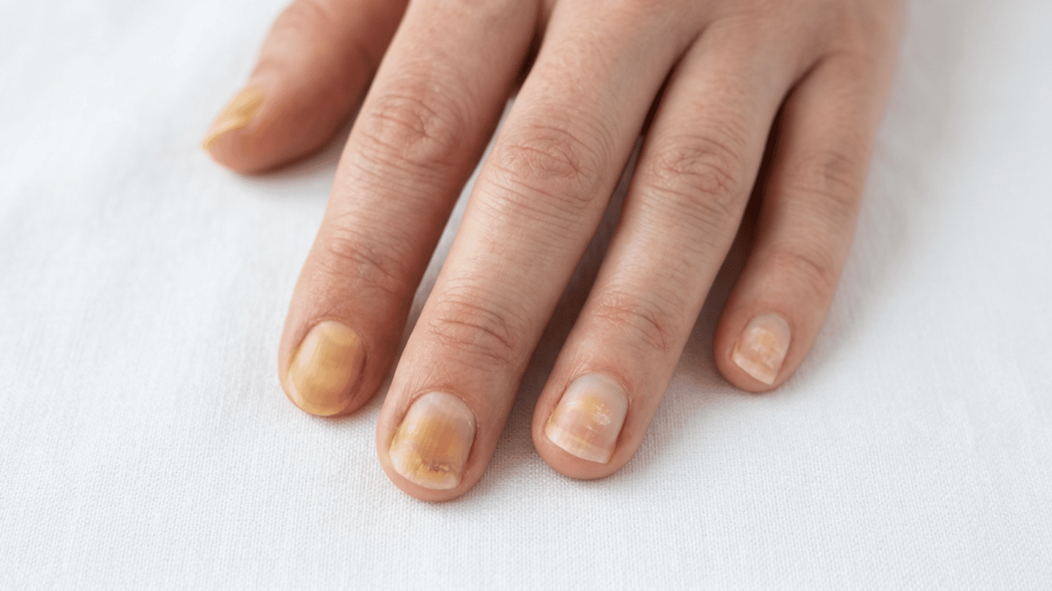 Hand with several fingernails showing mild yellow discoloration on a white surface.