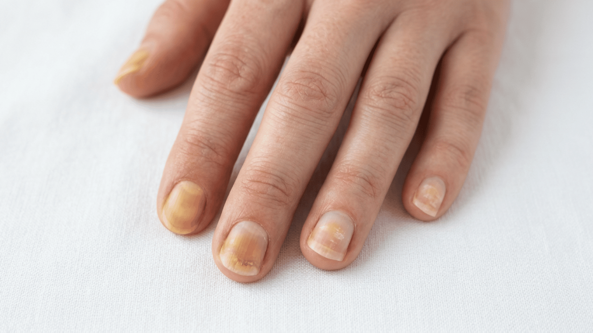 Hand with several fingernails showing mild yellow discoloration on a white surface.