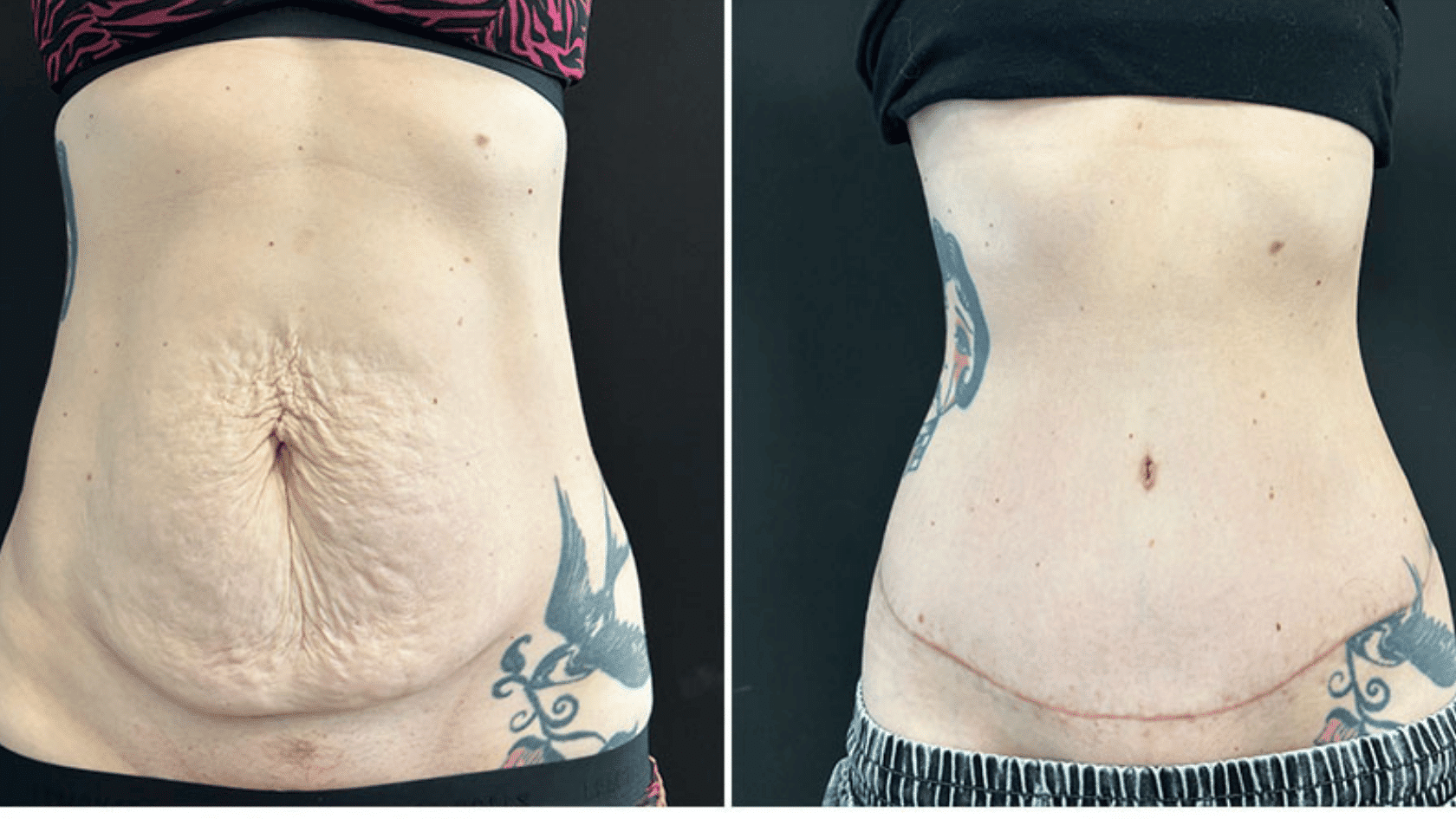 Side-by-side comparison photos showing the before and after results of a tummy tuck (abdominoplasty) surgery removing loose skin on a female torso.