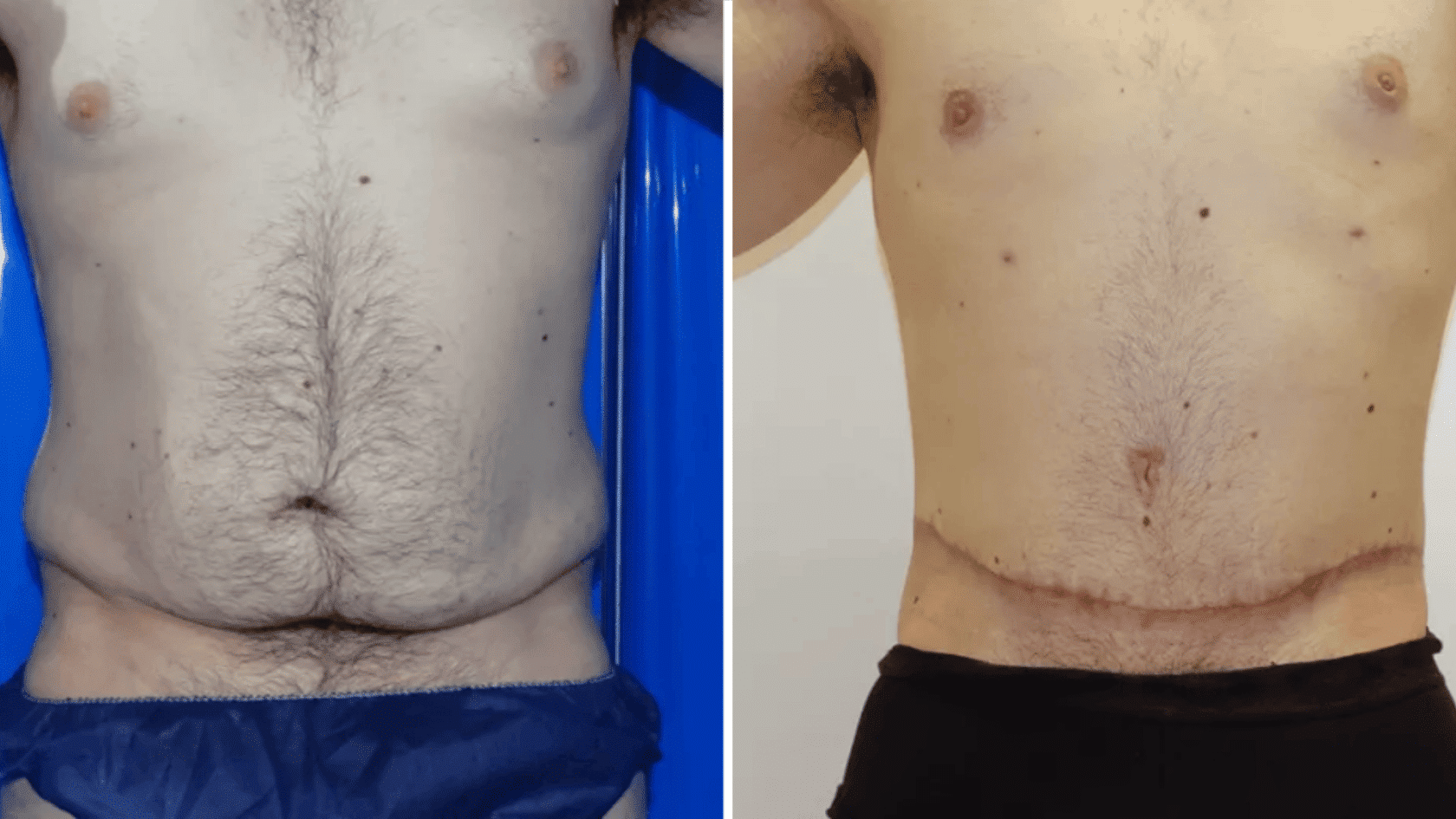 Side-by-side comparison photos showing the before and after results of a tummy tuck (abdominoplasty) surgery on a male torso.