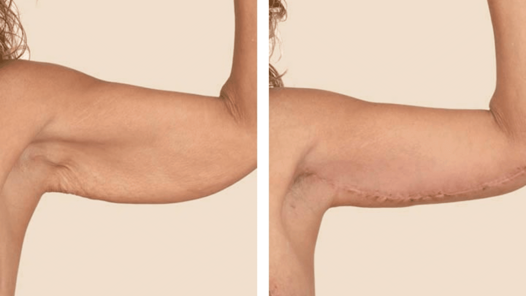 Side-by-side comparison photos showing the before and after results of an arm lift (brachioplasty) surgery on a person's upper arm.