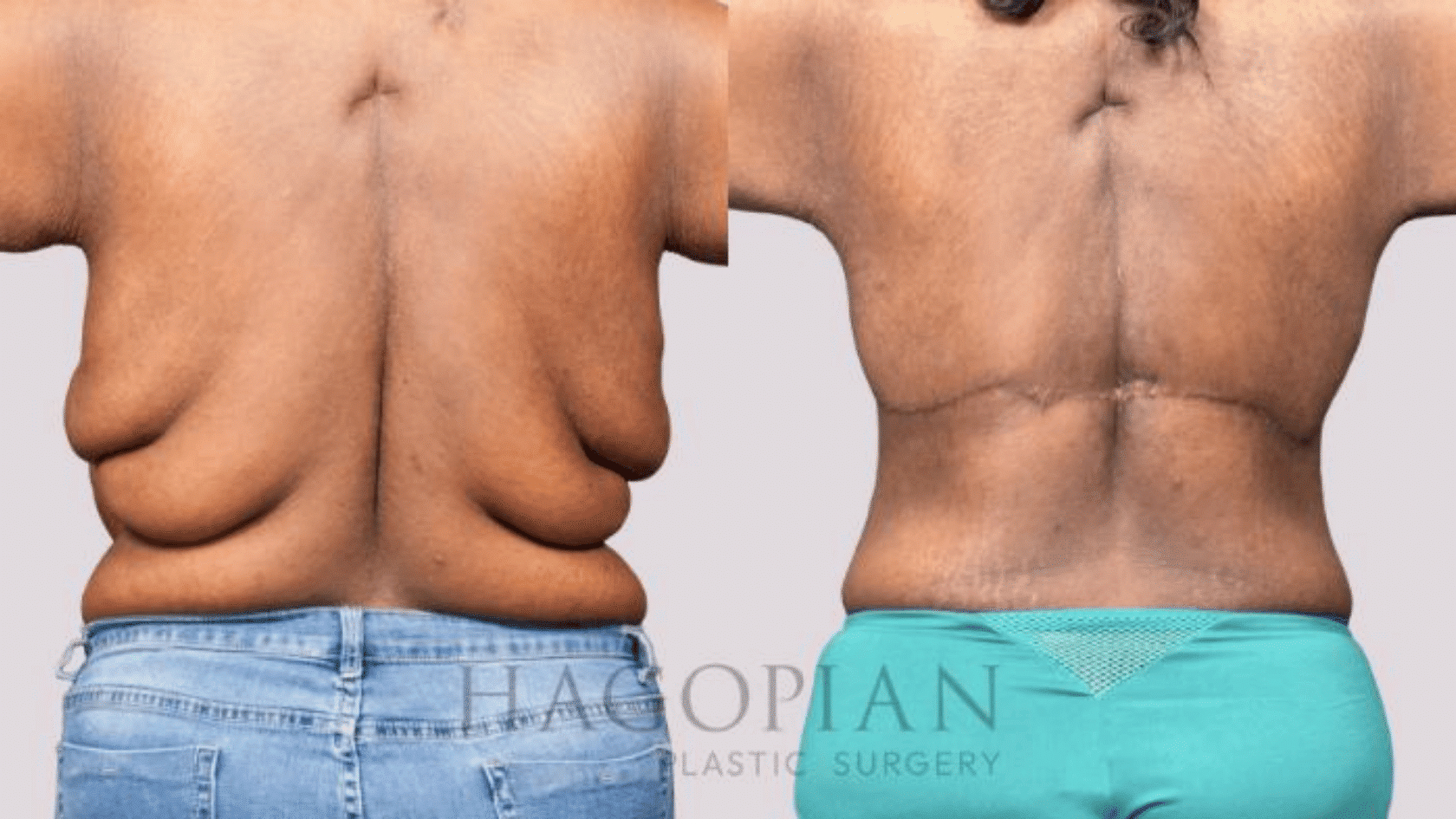 Side-by-side comparison photos showing the before and after results of an upper back lift (torsoplasty) surgery removing excess skin rolls.
