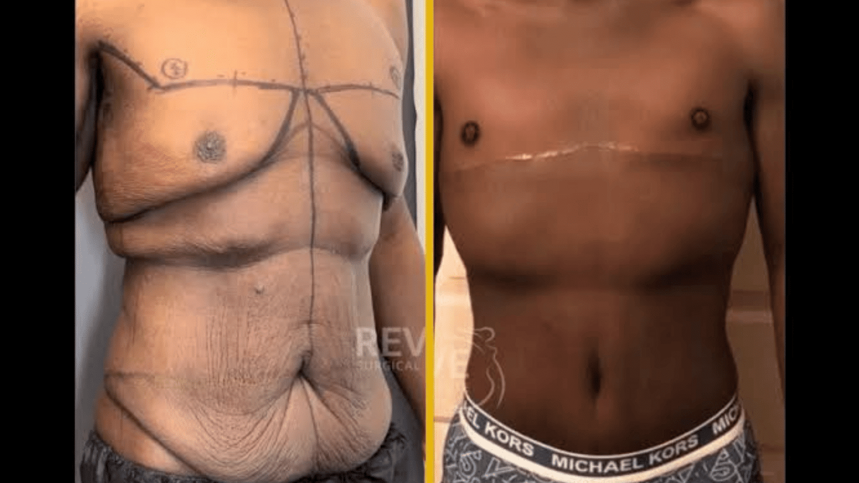 Side-by-side comparison photos showing the before and after results of chest masculinization and abdominal skin removal surgery on a male torso.
