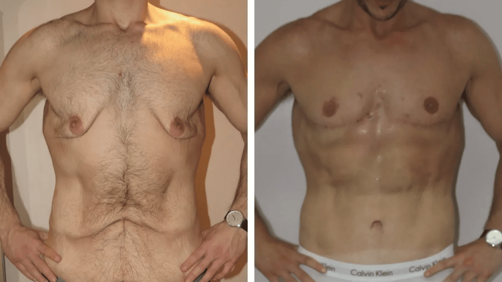 Side-by-side comparison photos showing the before and after results of gynecomastia reduction surgery and excess skin removal on a male upper body.