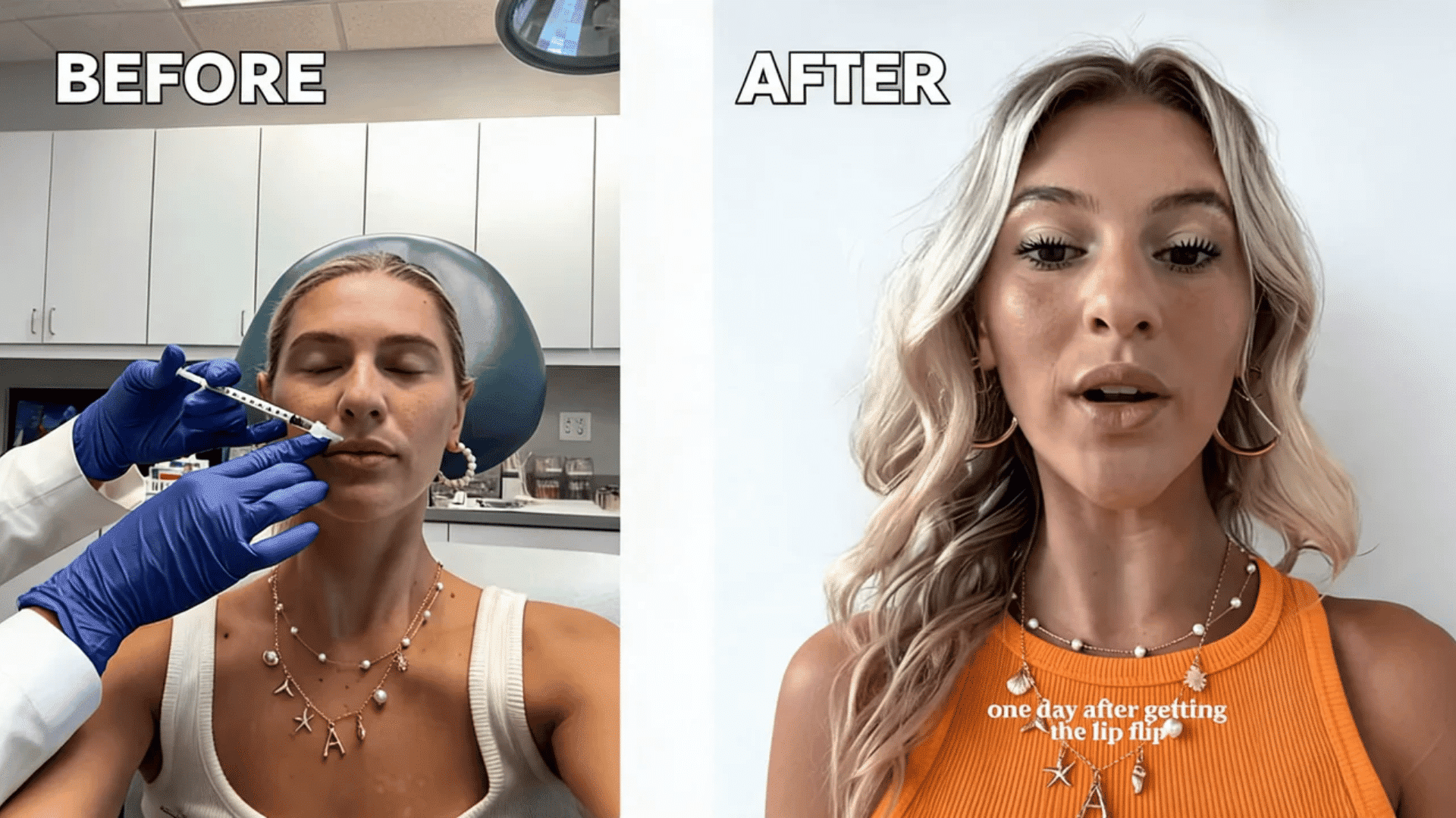 Lip flip treatment and one-day-after result shown in a side-by-side comparison