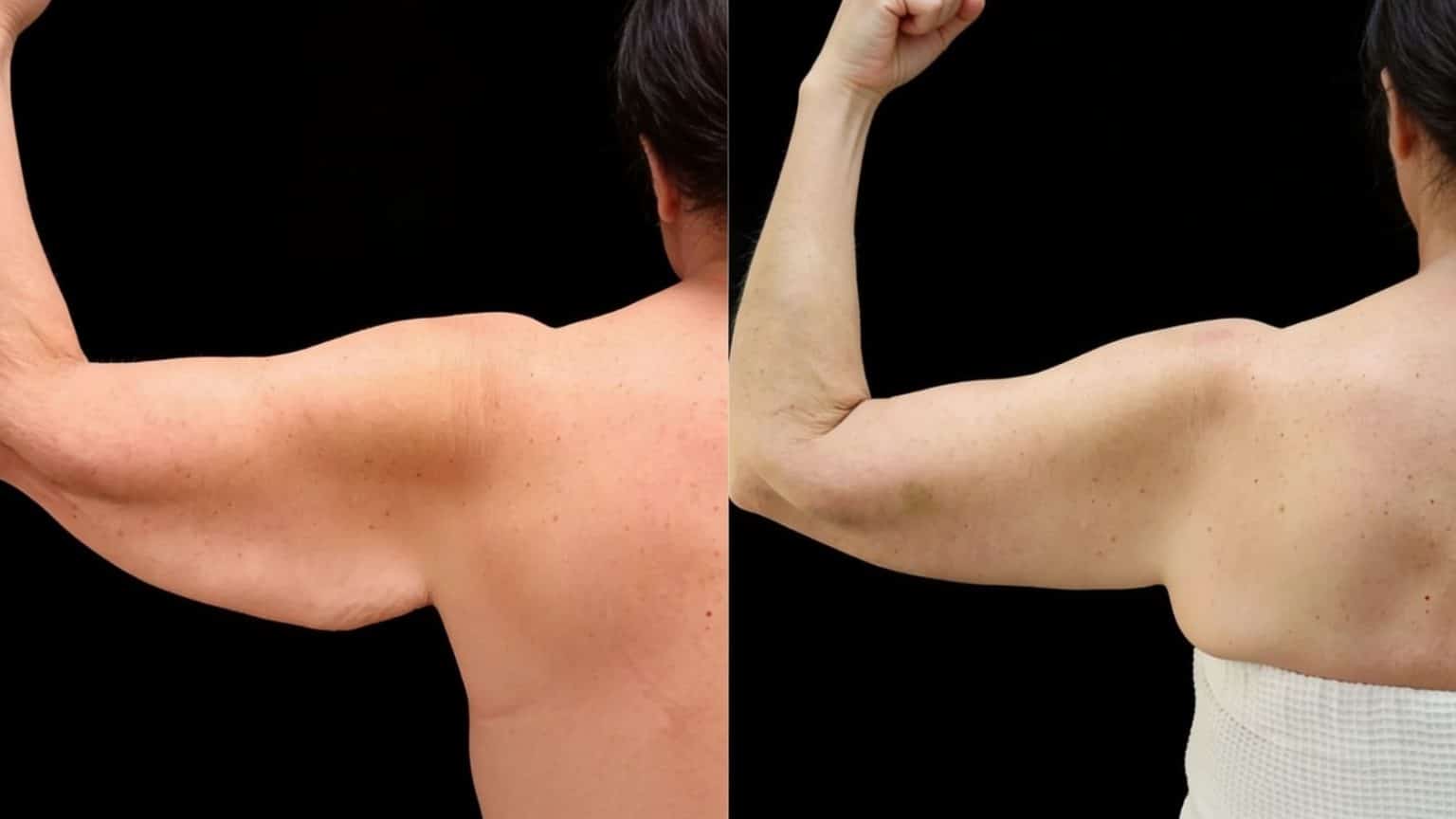 skin-removal-surgery