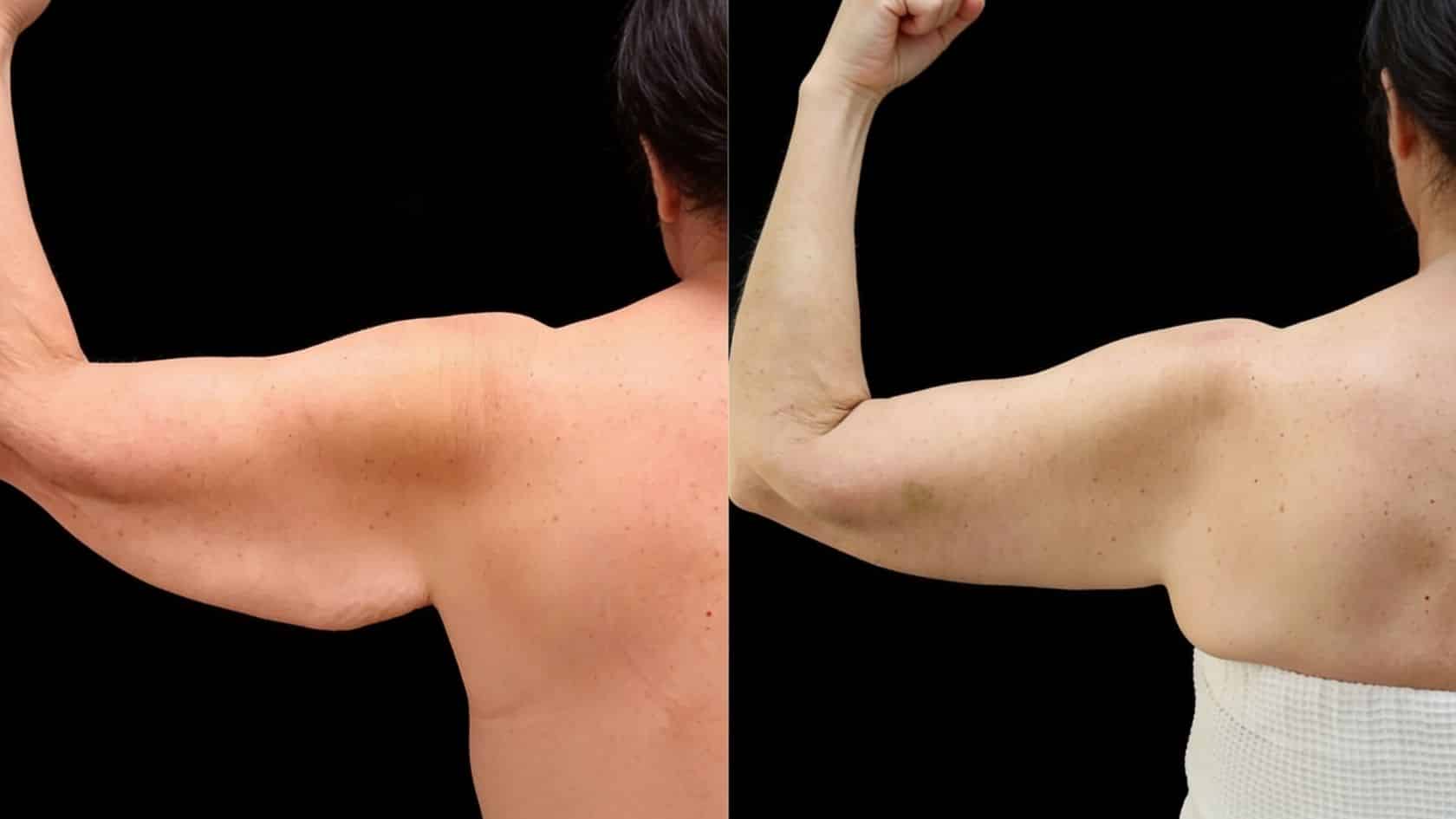 skin-removal-surgery