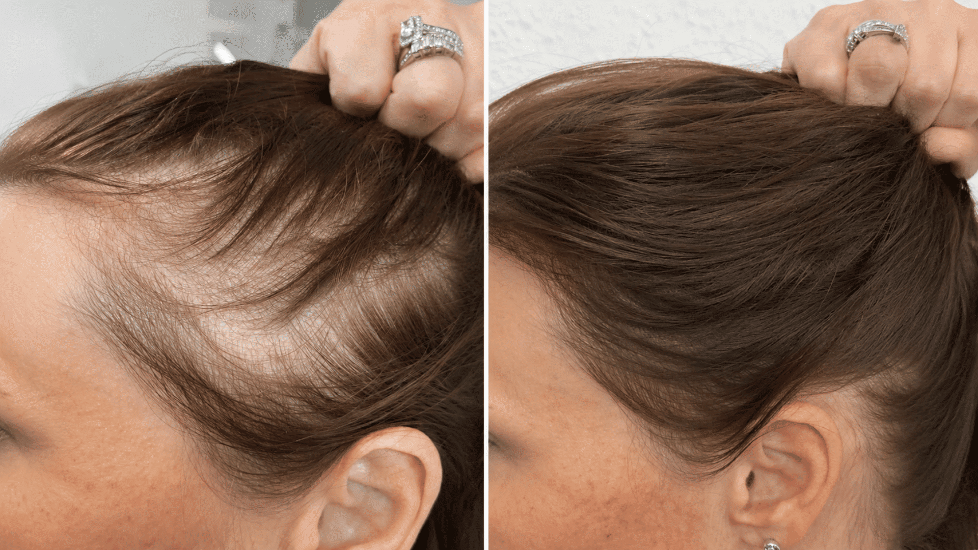 Scalp micropigmentation follows a structured process spread across multiple sessions
